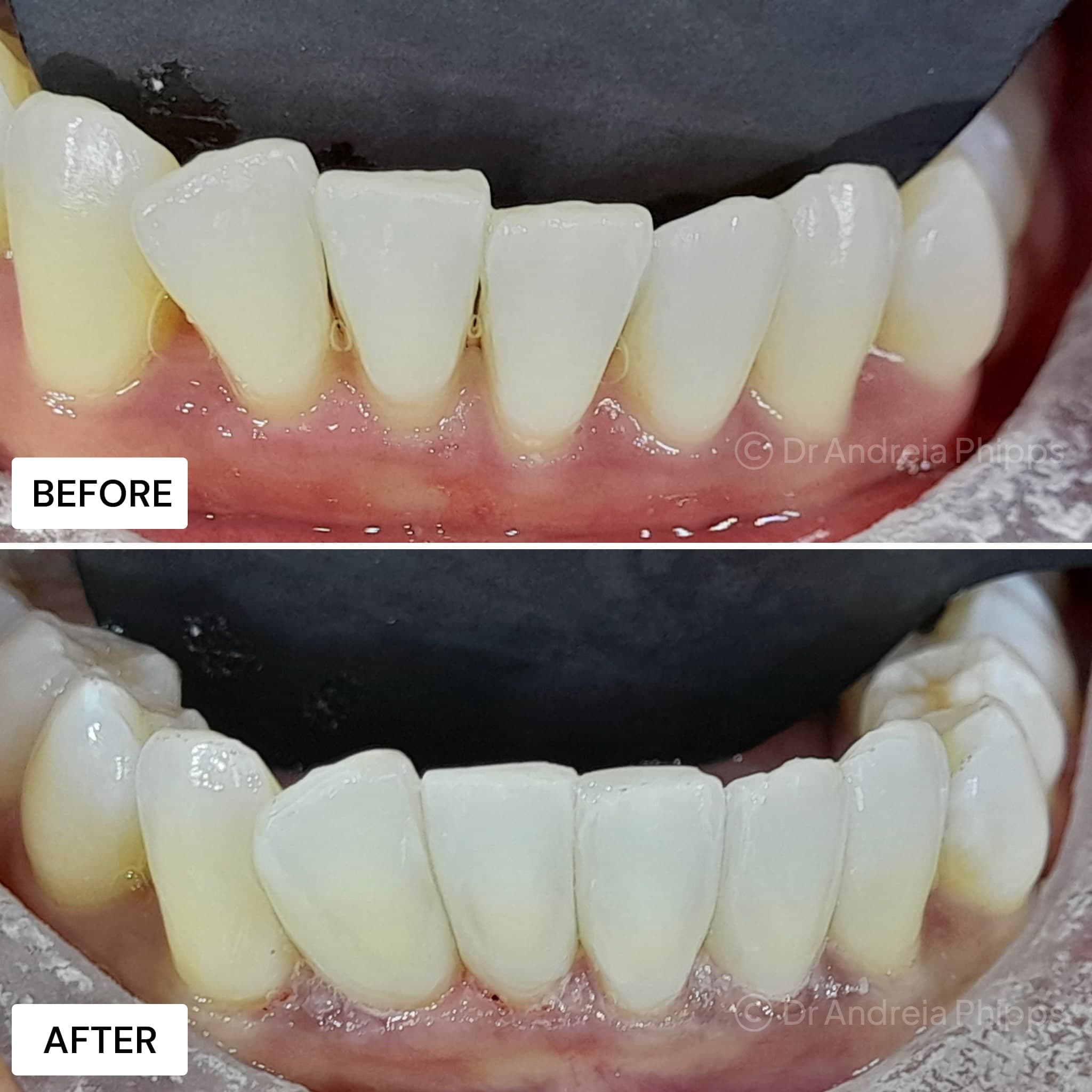 Composite Bonding - Before and After