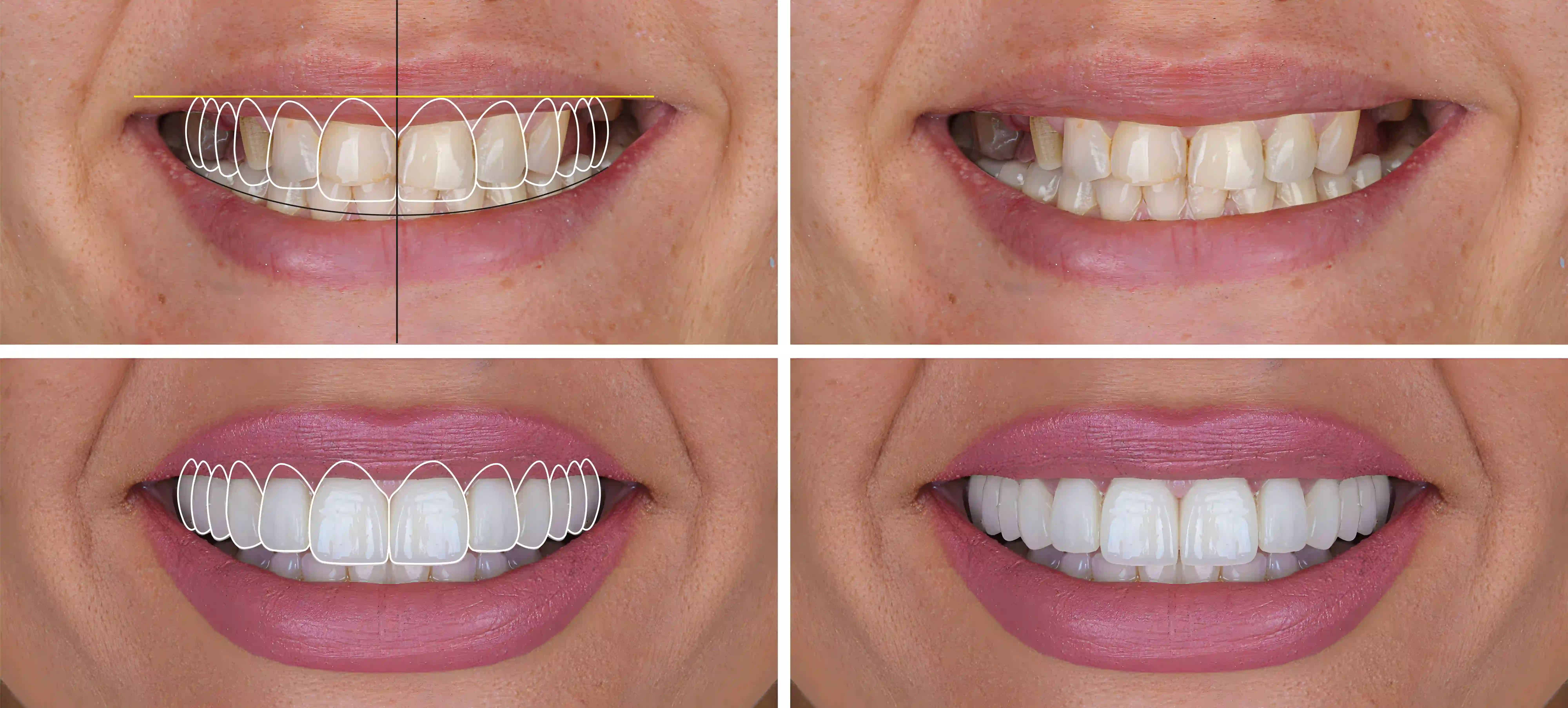 Dental Veneers: Are They Worth It in 2026? Costs, Results, and Longevity Explained