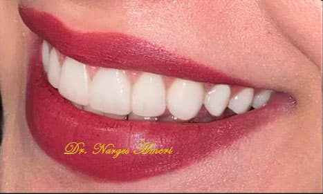 After Composite Veneers