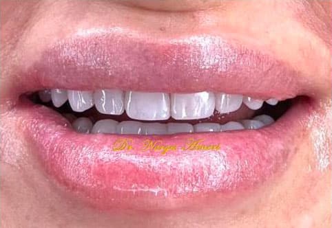 After Composite Bonding