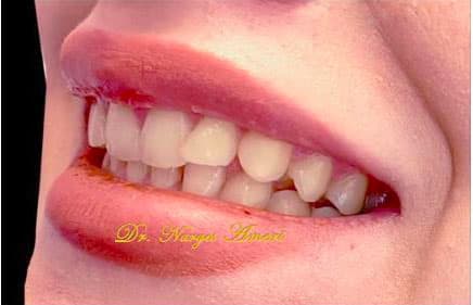 Before Composite Veneers