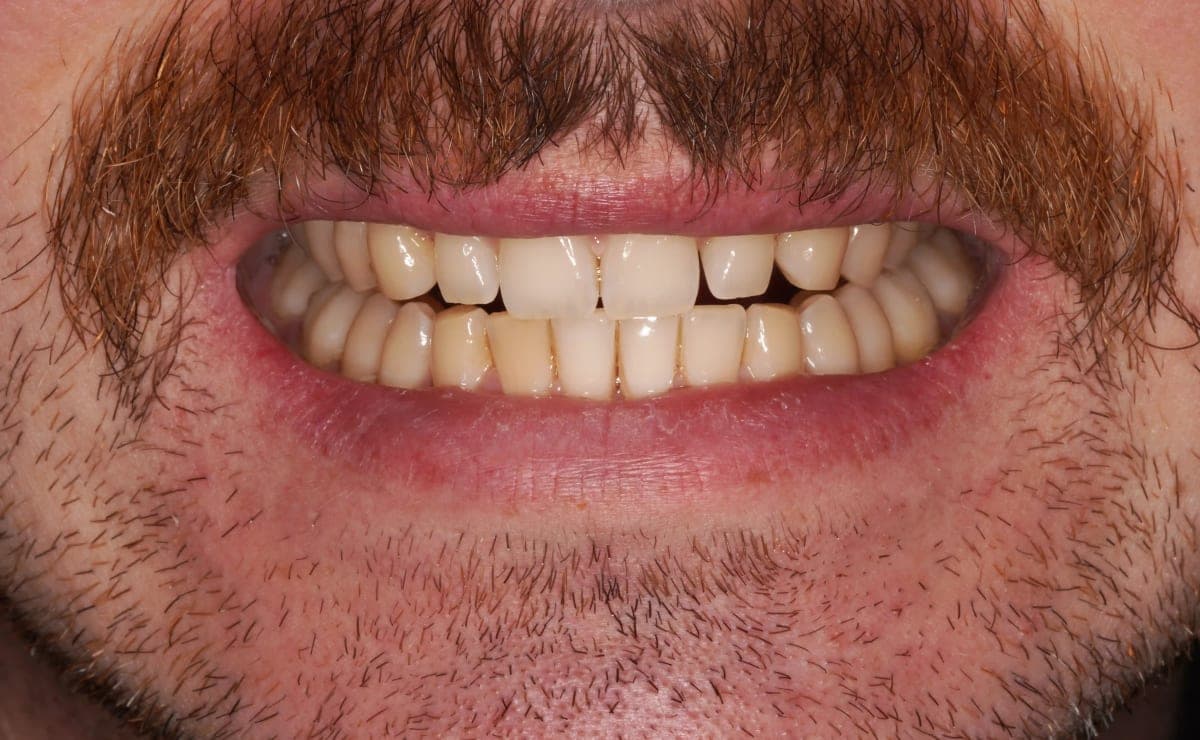 Before Teeth Whitening