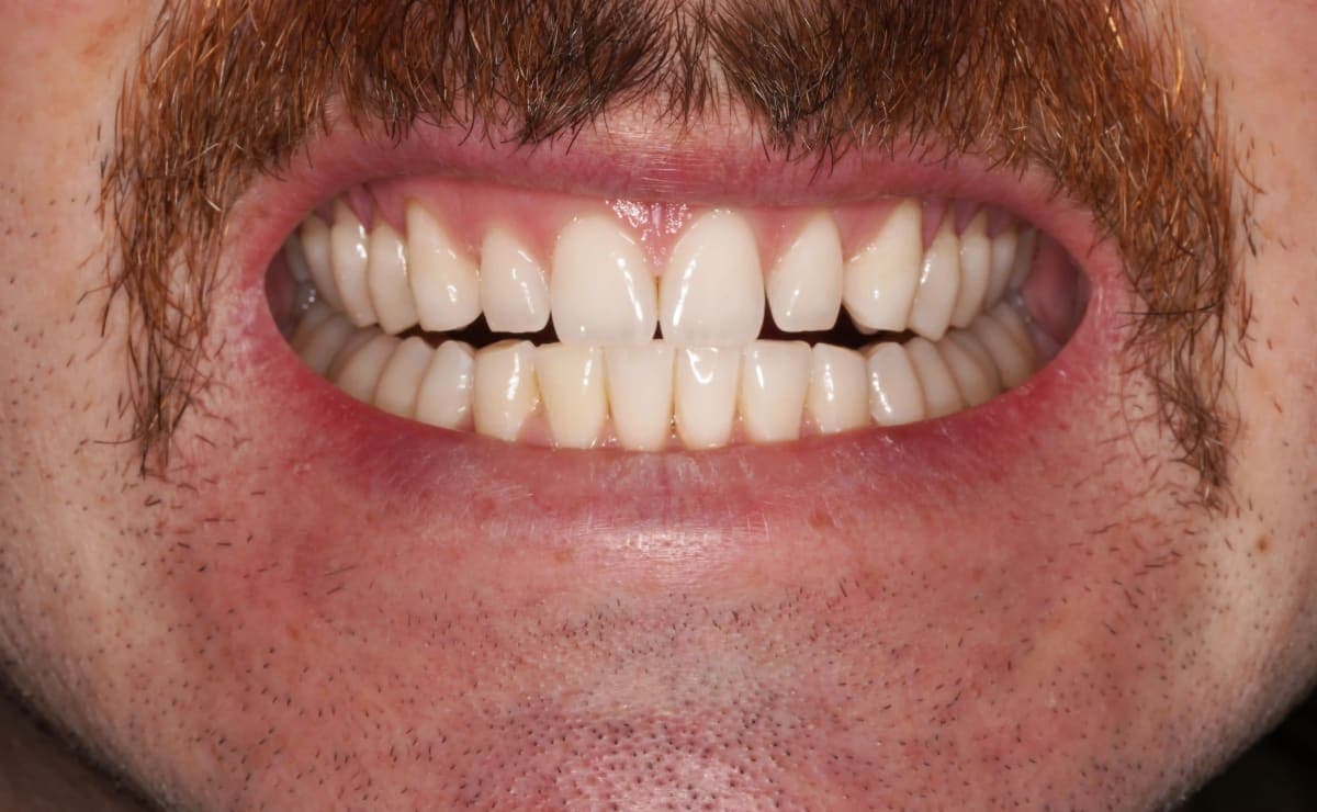 After Teeth Whitening