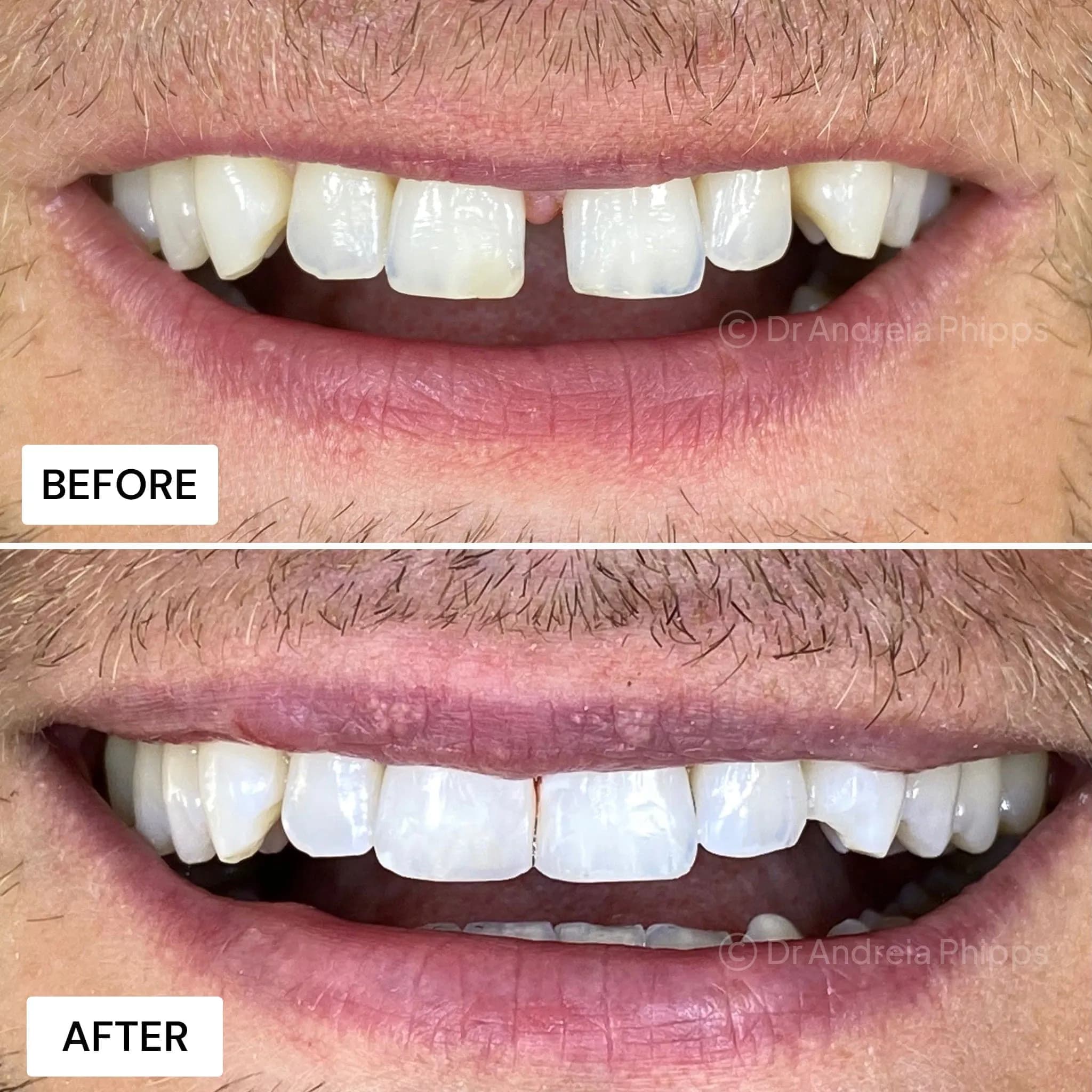 Composite Bonding - Before and After