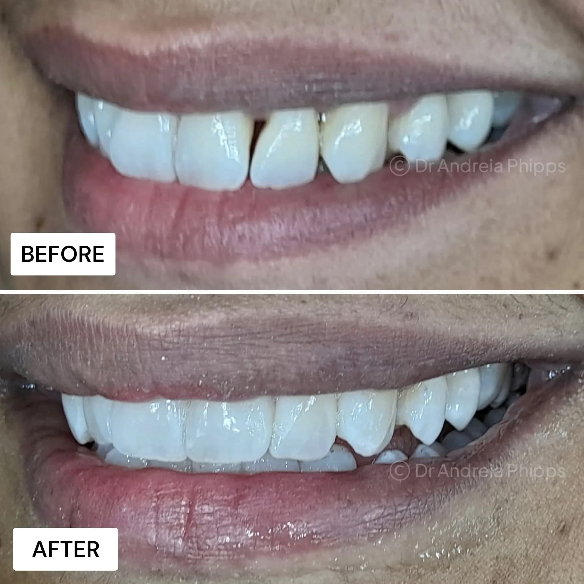 Composite Bonding - Before and After
