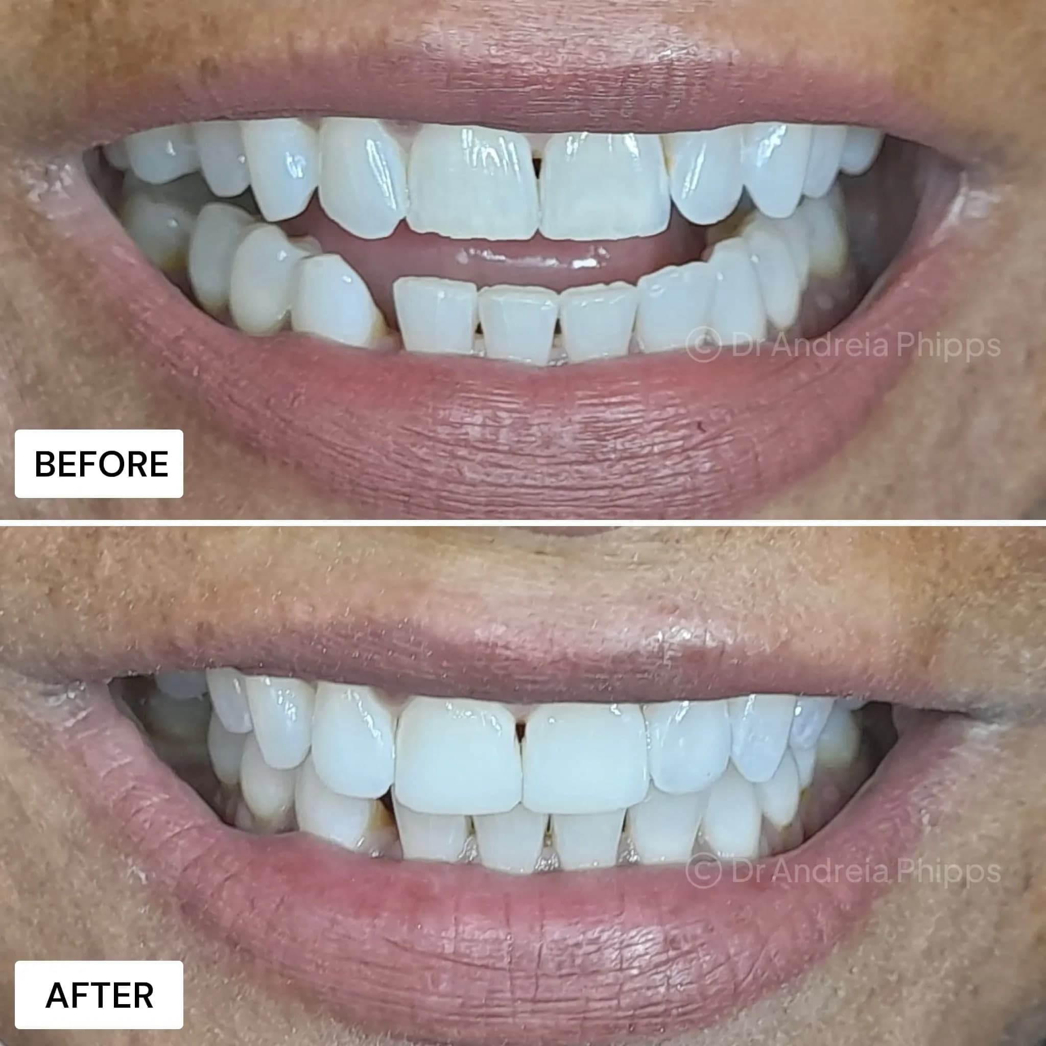 Composite Bonding - Before and After