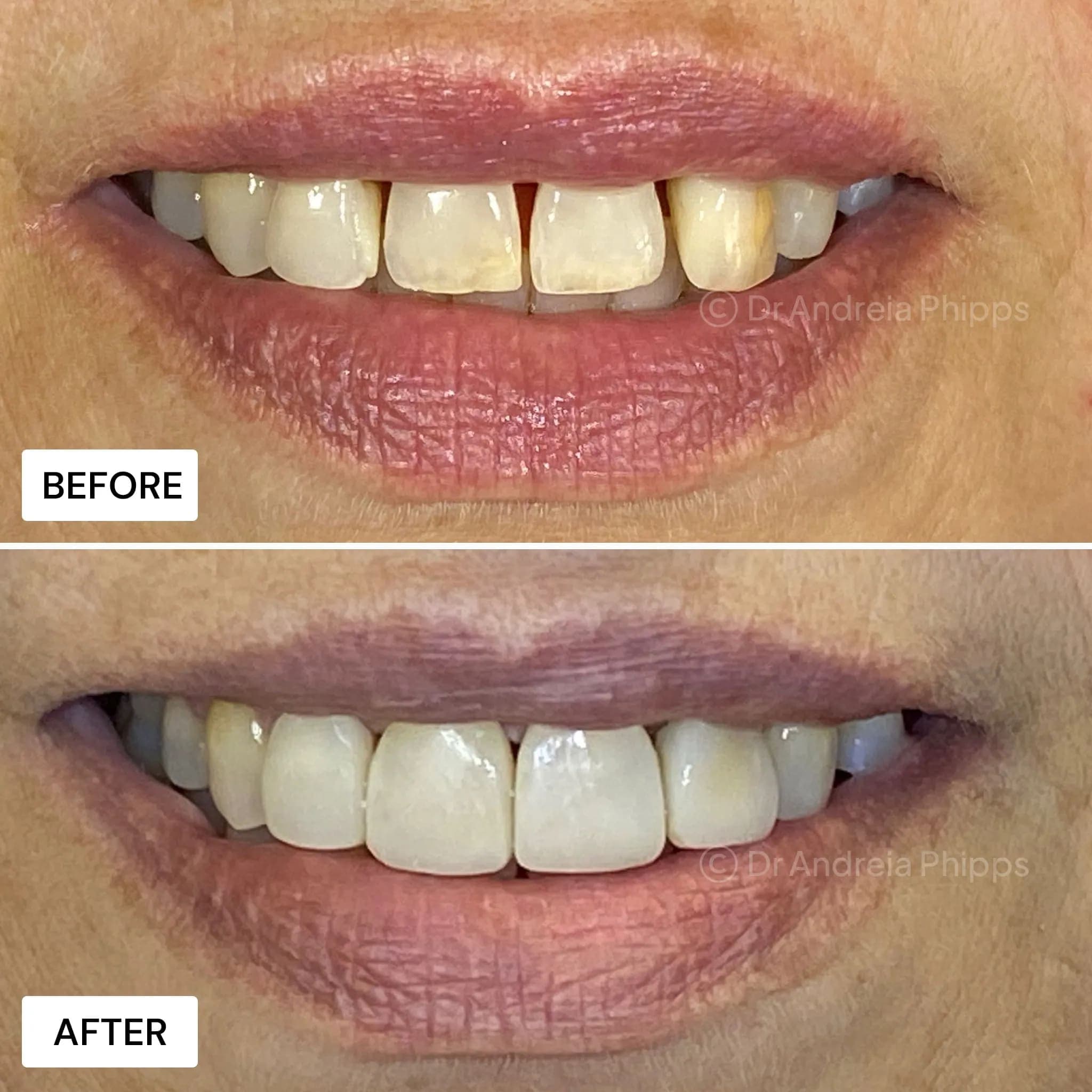 Composite Bonding - Before and After