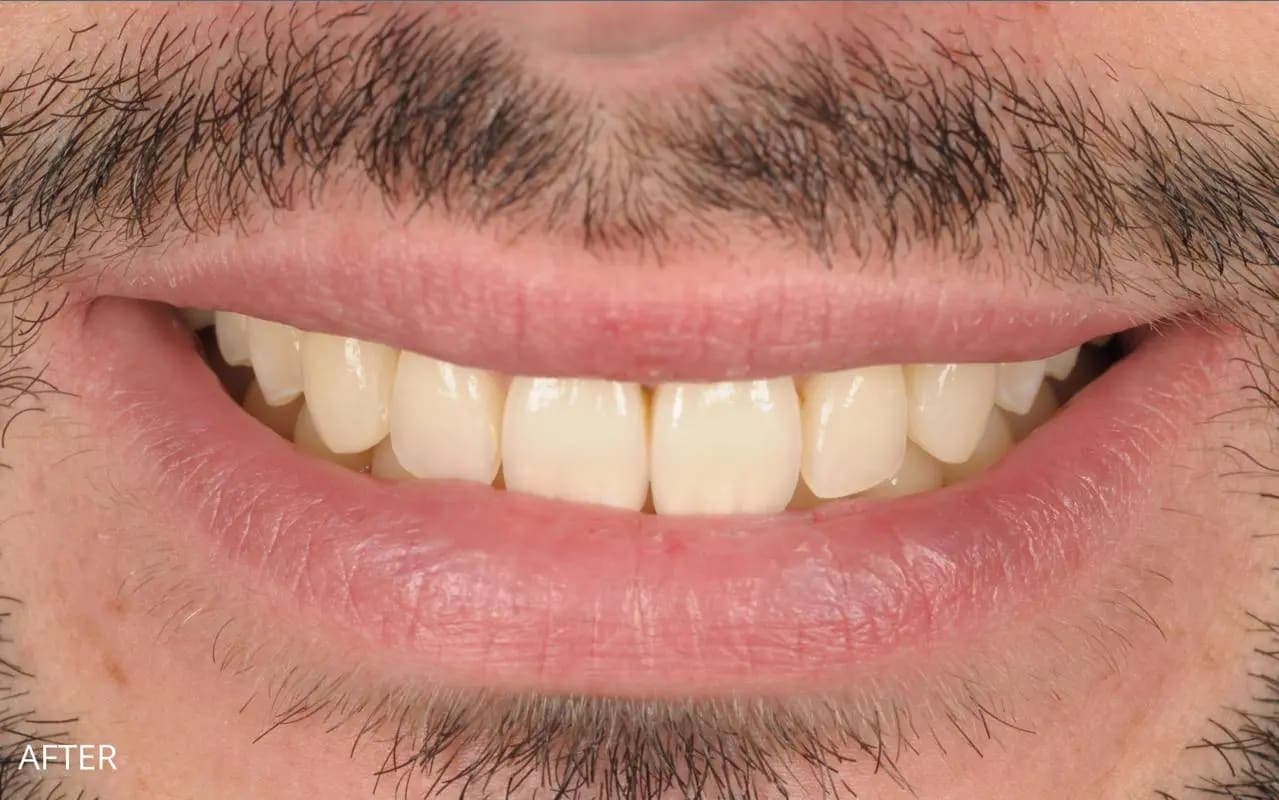 After Full Veneers