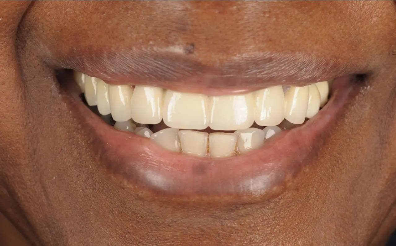 After Tooth Implants