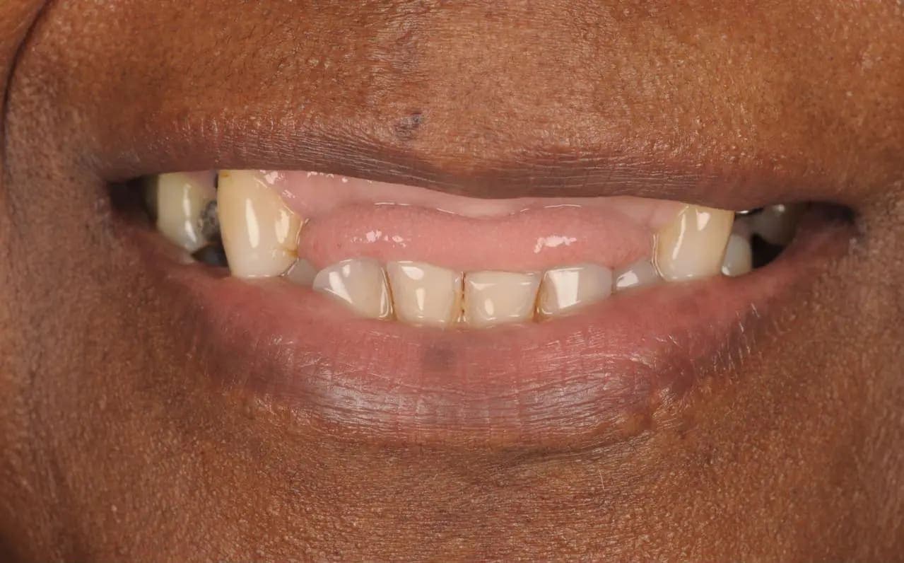 Before Tooth Implants