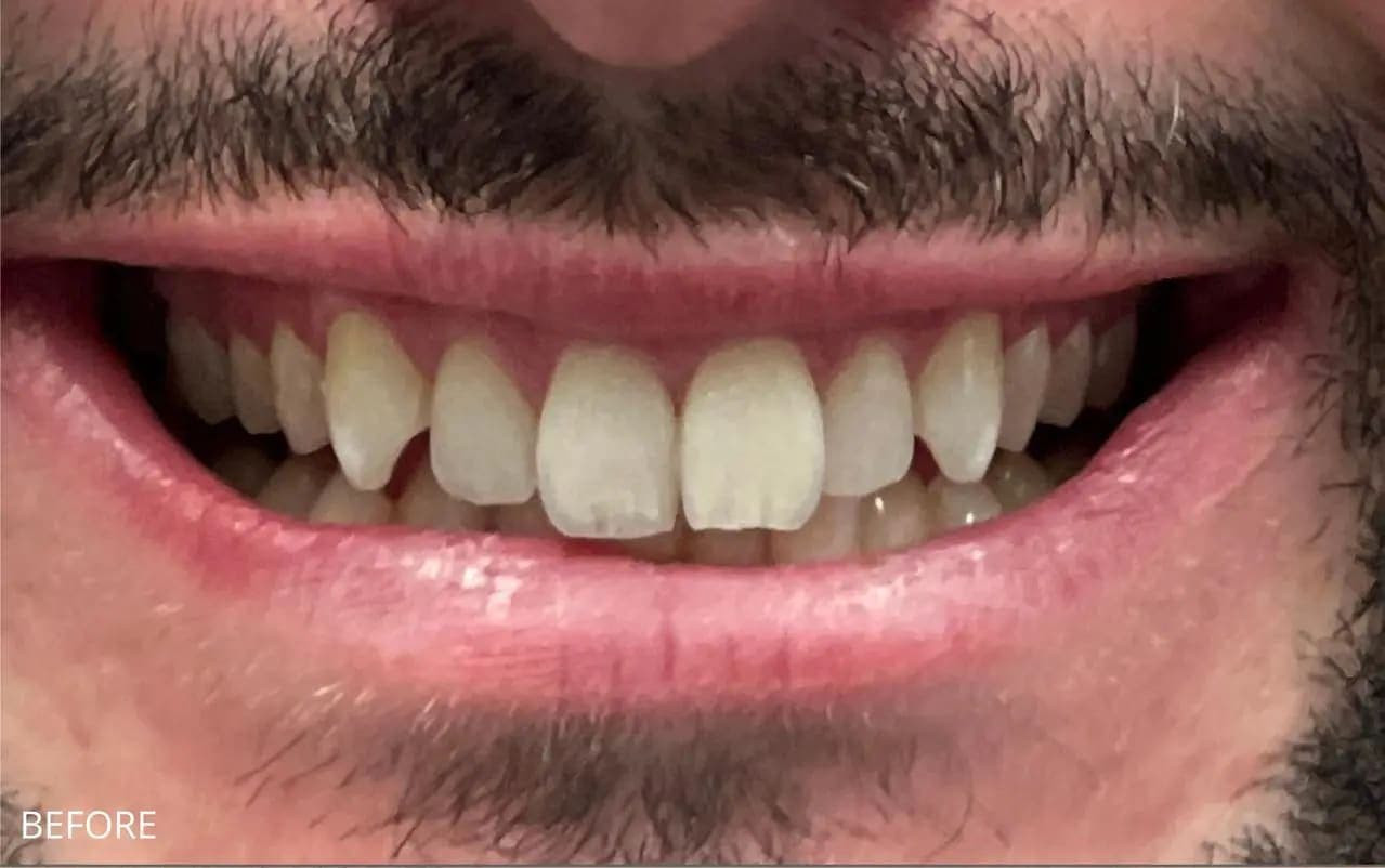 Before Full Veneers
