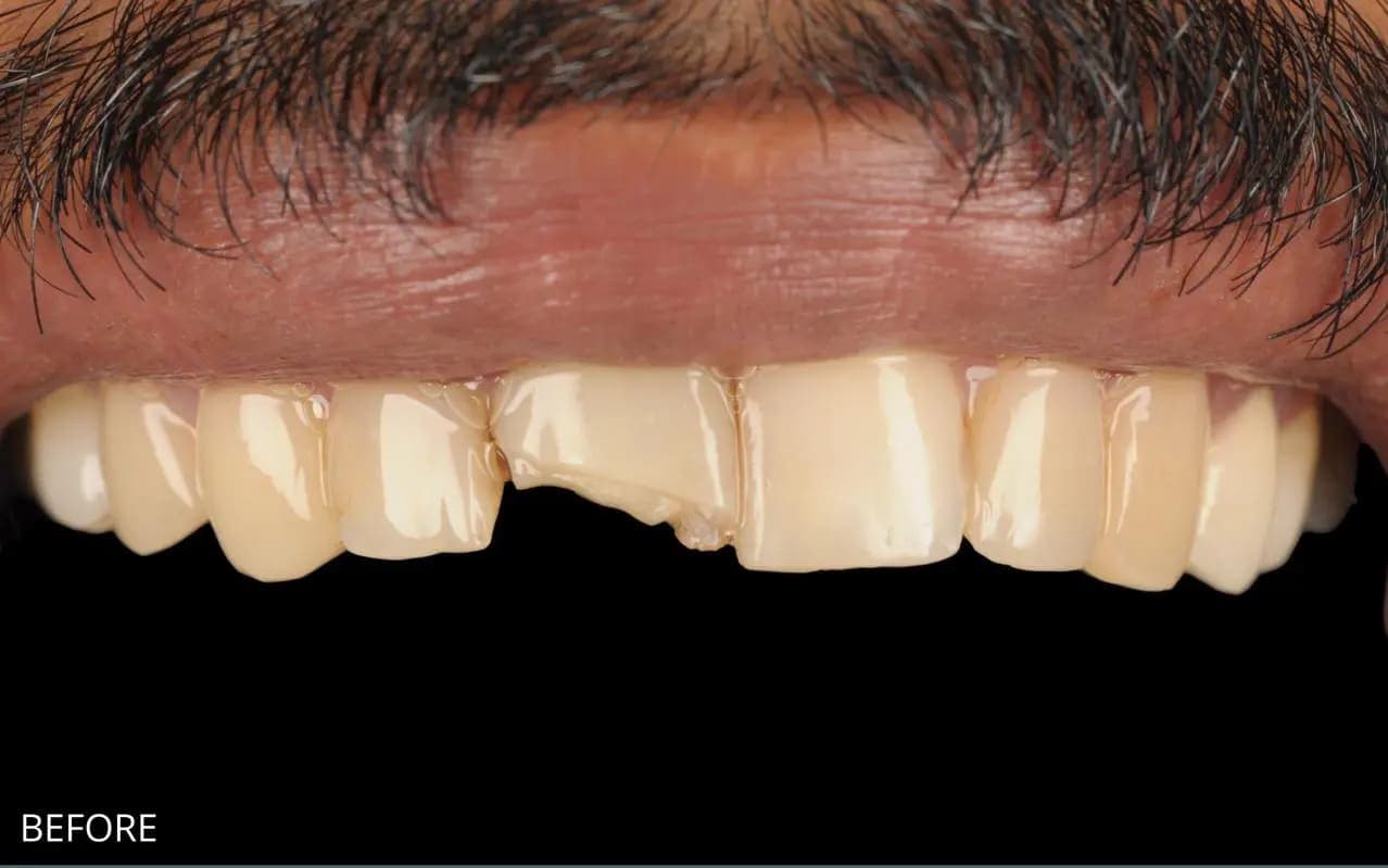 Before Composite Bonding