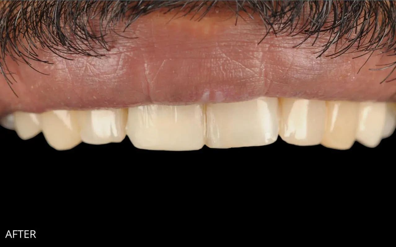 After Composite Bonding