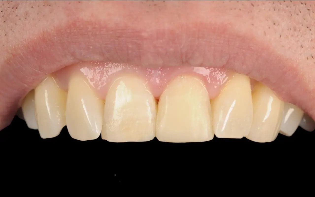 After Composite Bonding