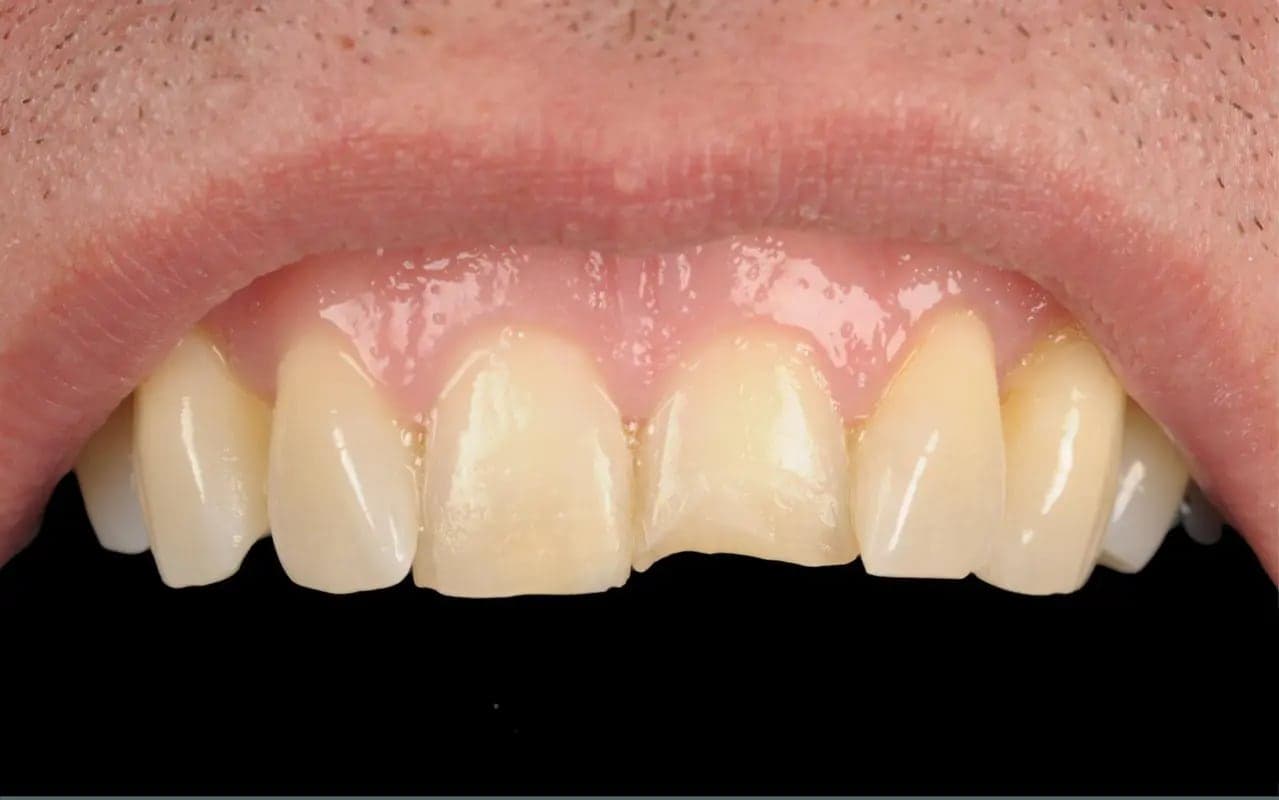 Before Composite Bonding