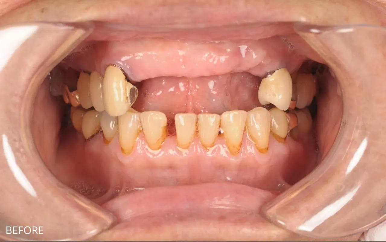 Before Implant Supported Bridge