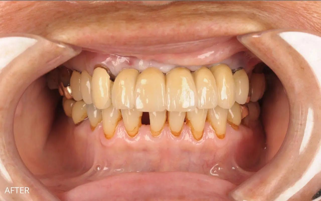 After Implant Supported Bridge