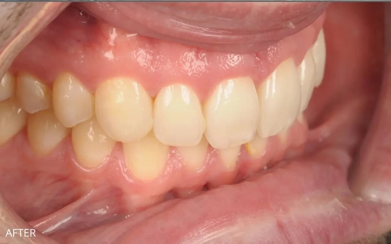 After Braces, Bonding & Whitening