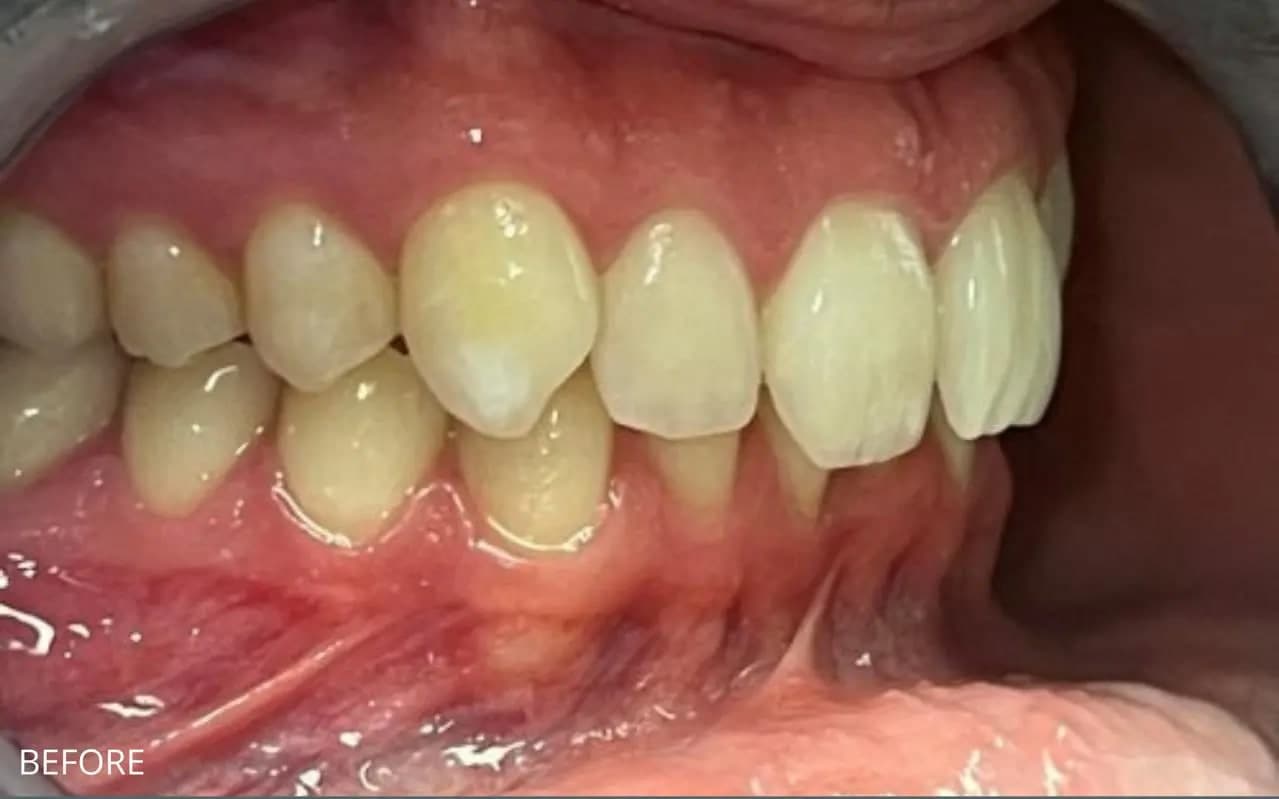 Before Braces, Bonding & Whitening