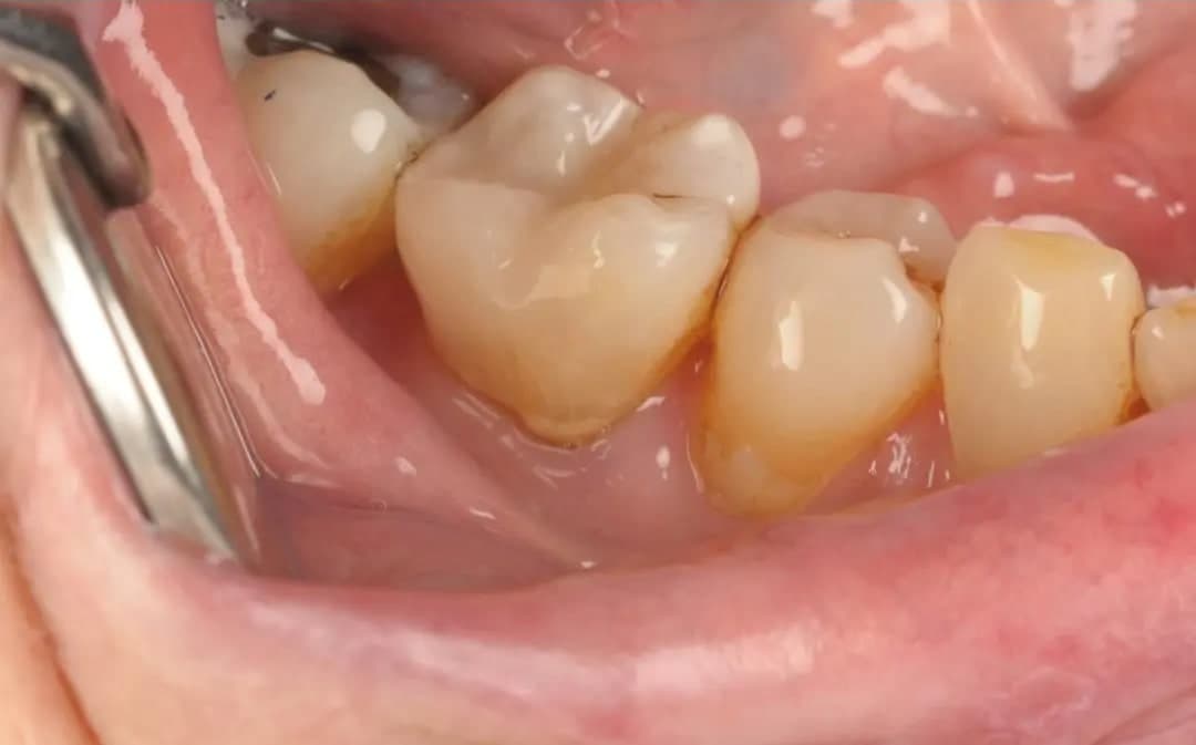 After White Fillings