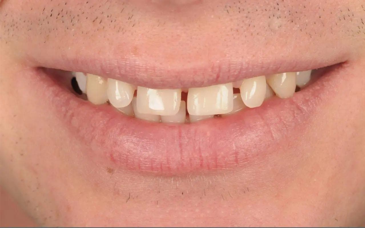 Before Gap Tooth Bonding