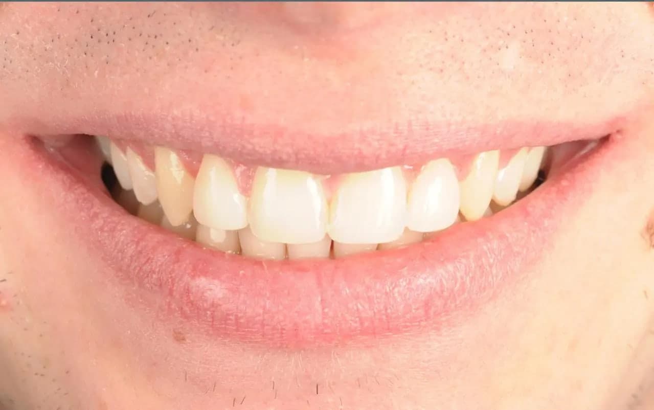 After Gap Tooth Bonding