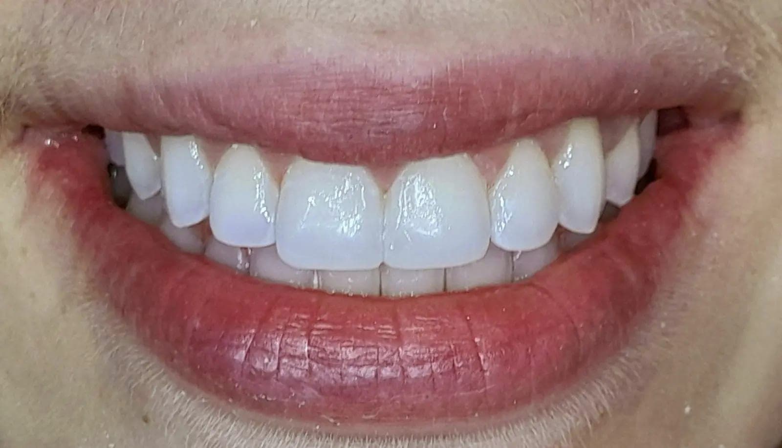 After Edge Bonding