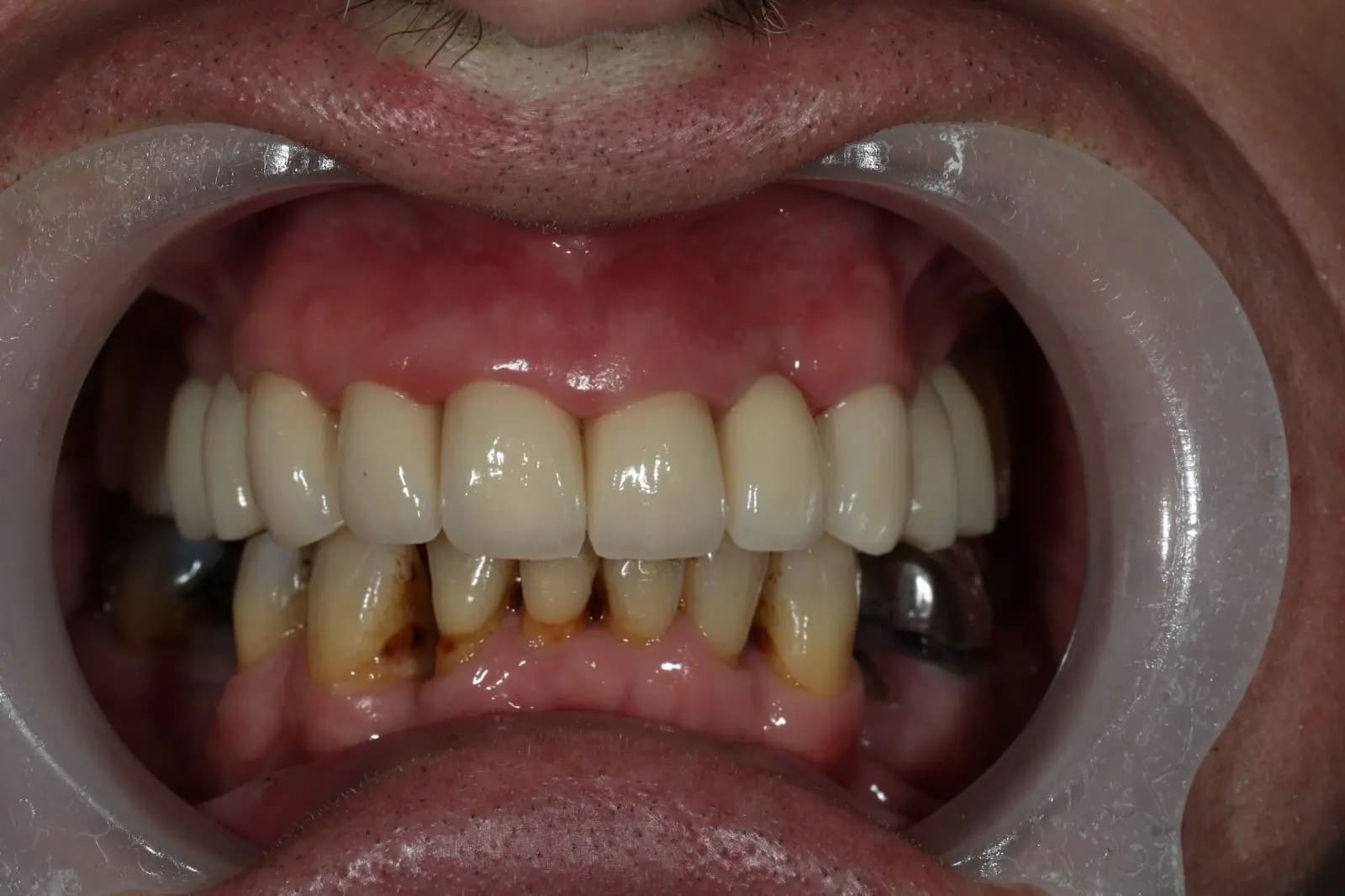After Full Mouth Rehabilitation