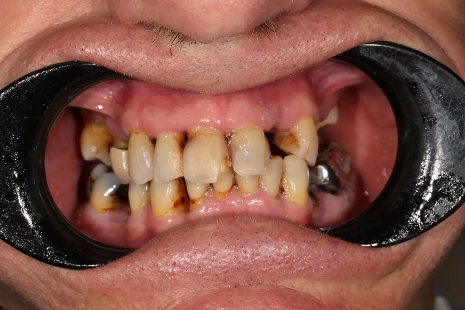 Before Full Mouth Rehabilitation