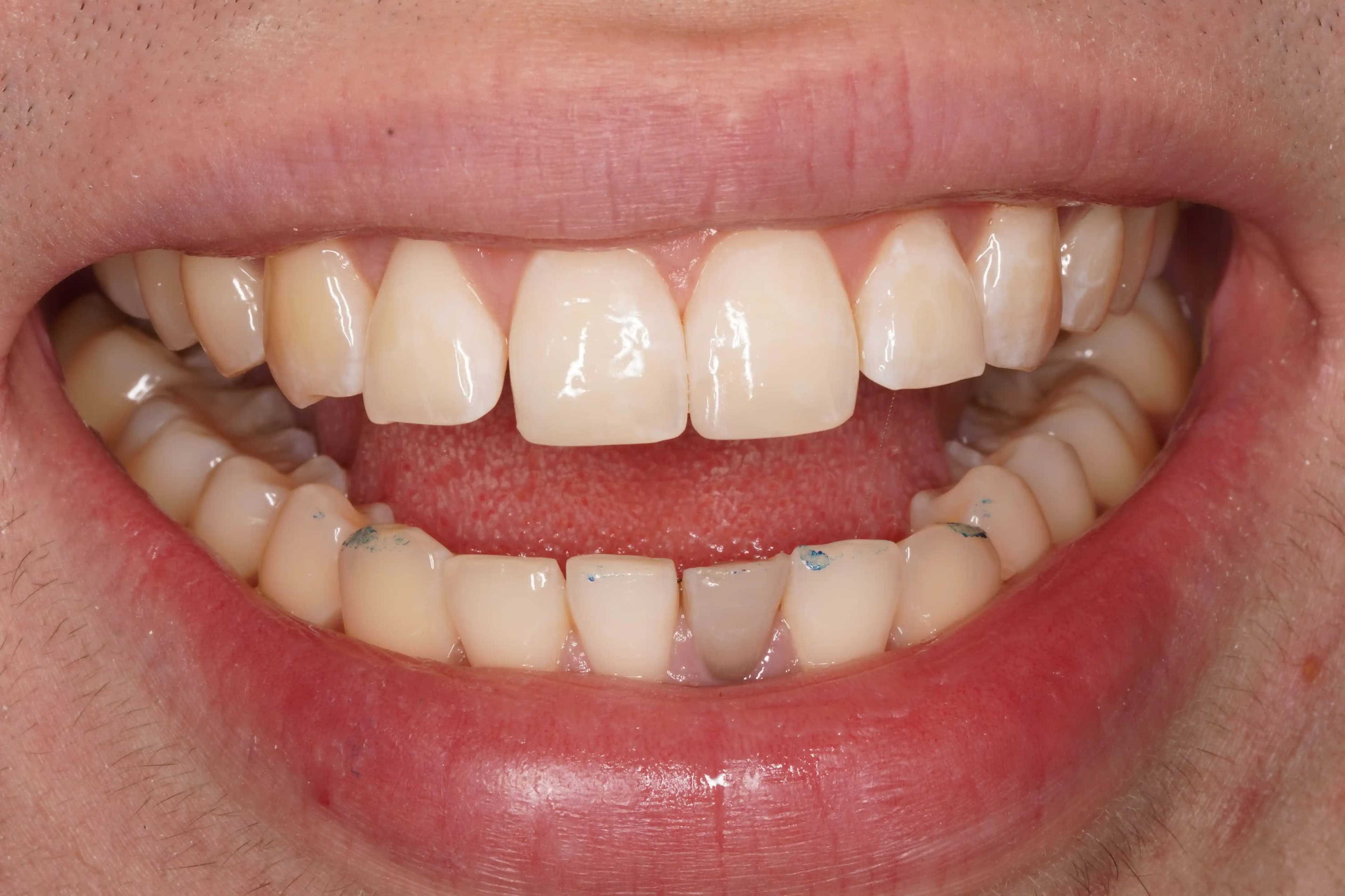 After Composite Bonding