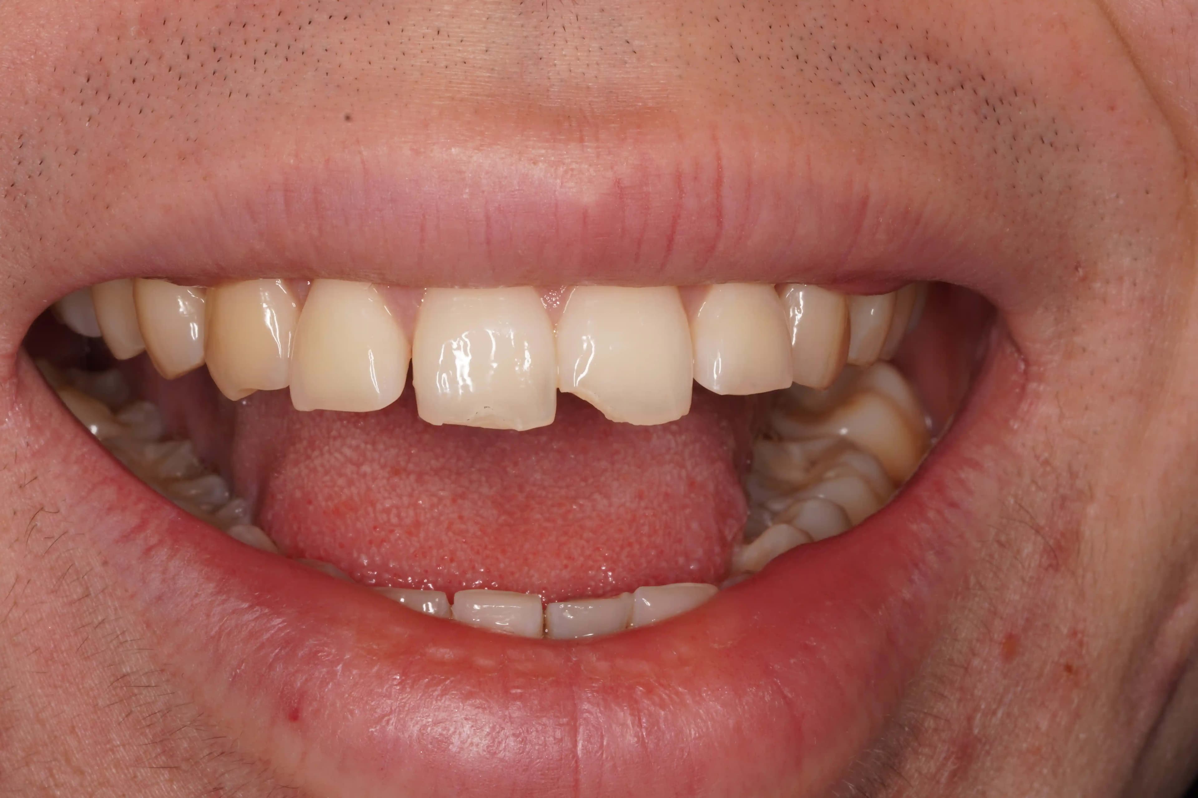 Before Composite Bonding