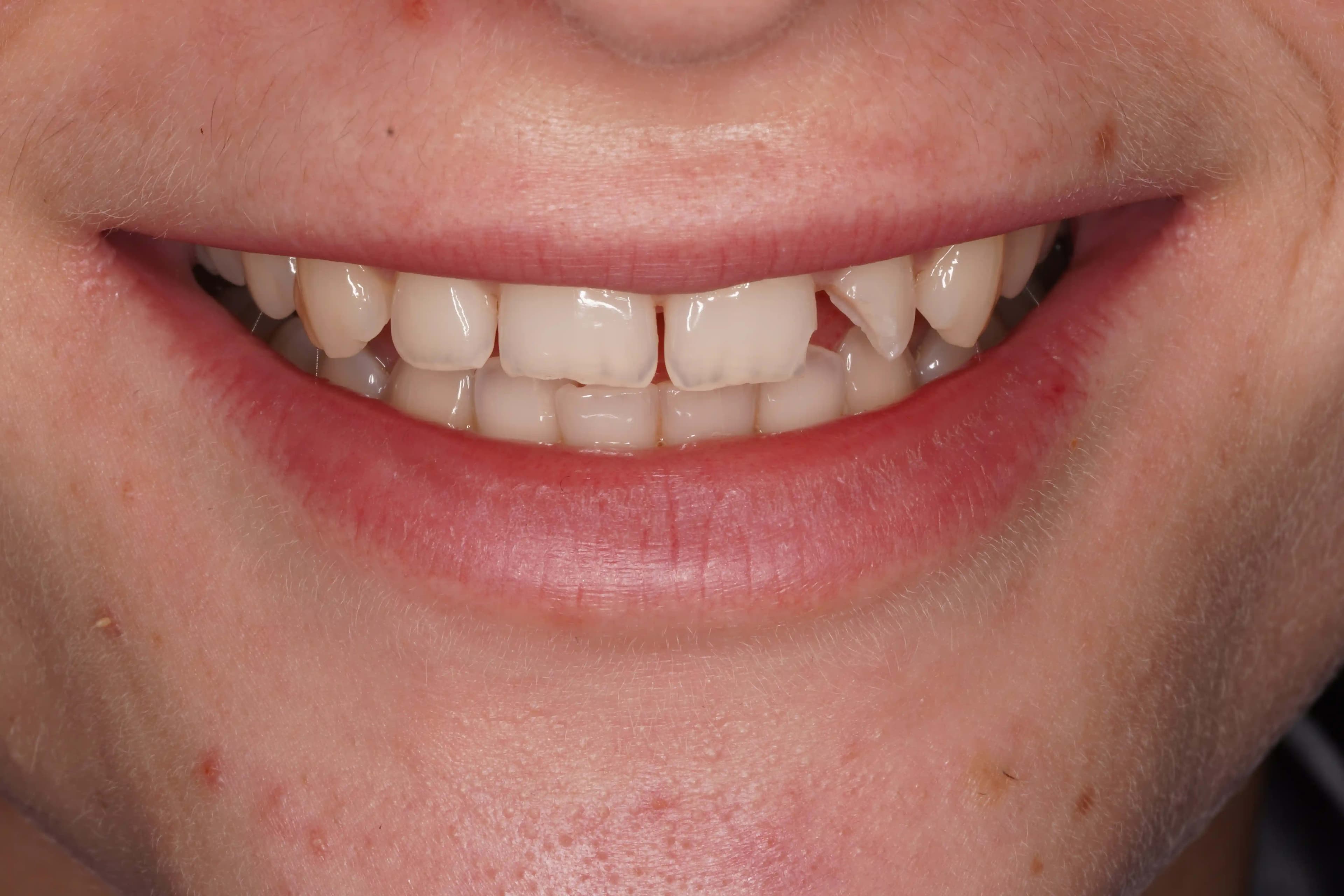 Before Composite Bonding