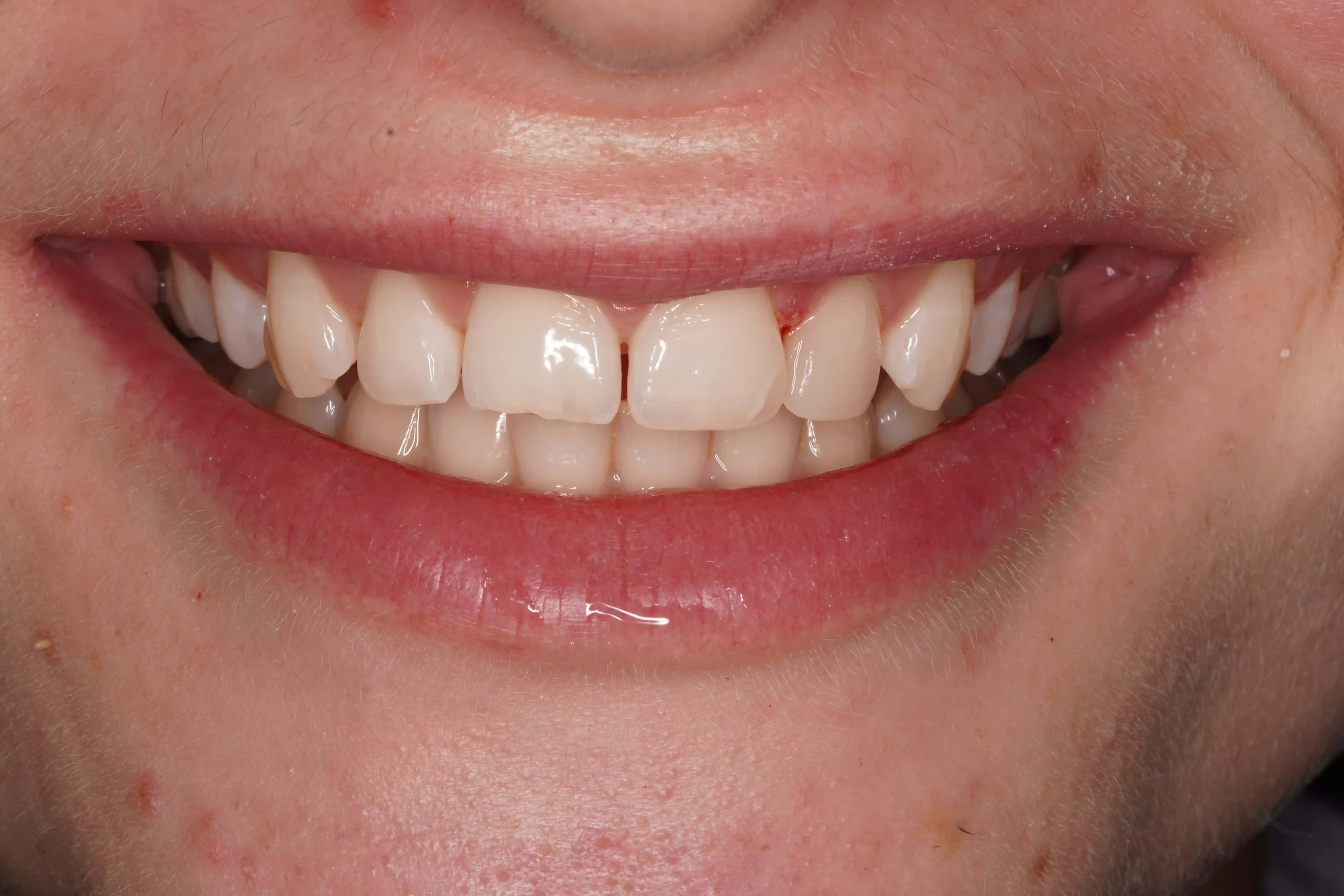 After Composite Bonding