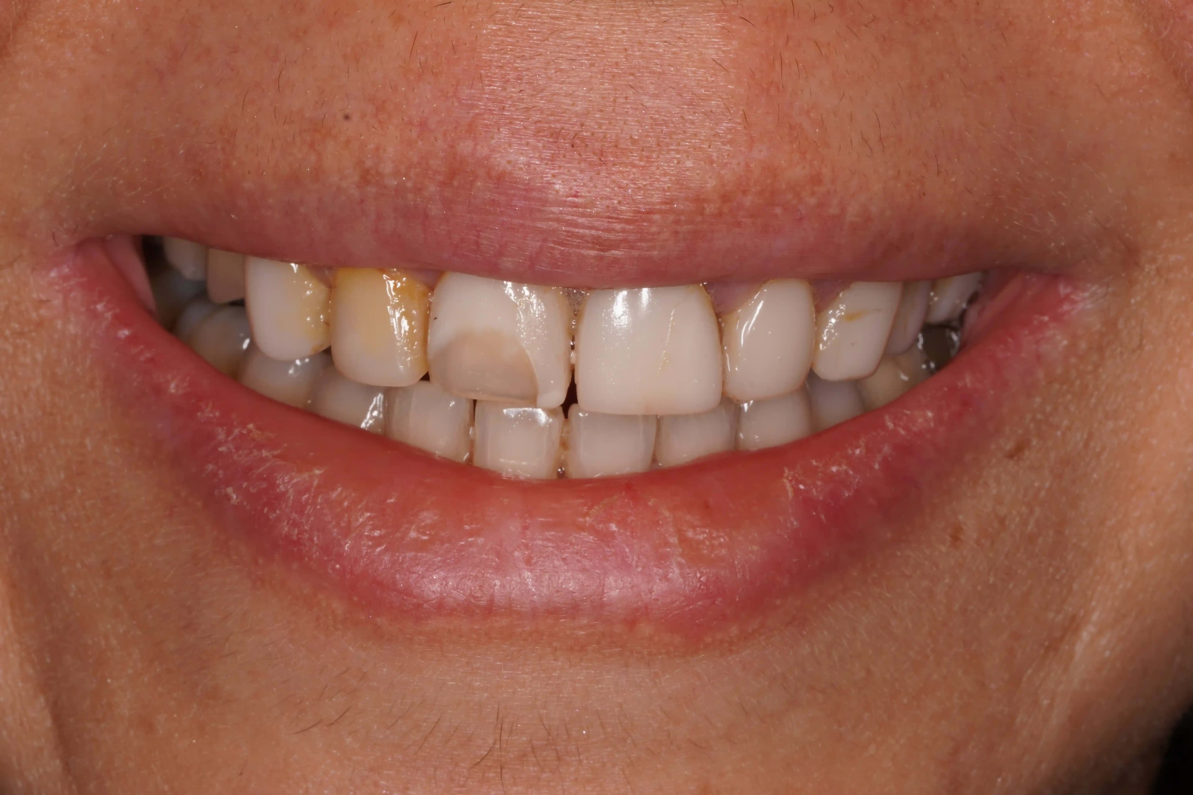 Before Composite Bonding
