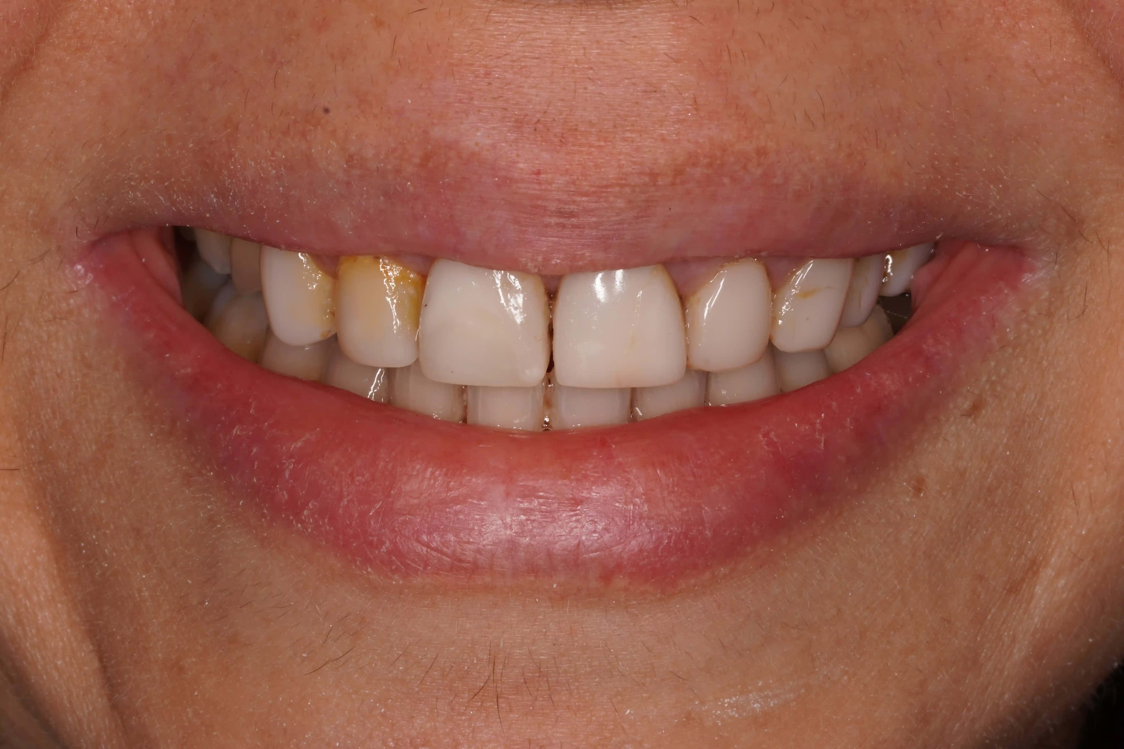 After Composite Bonding