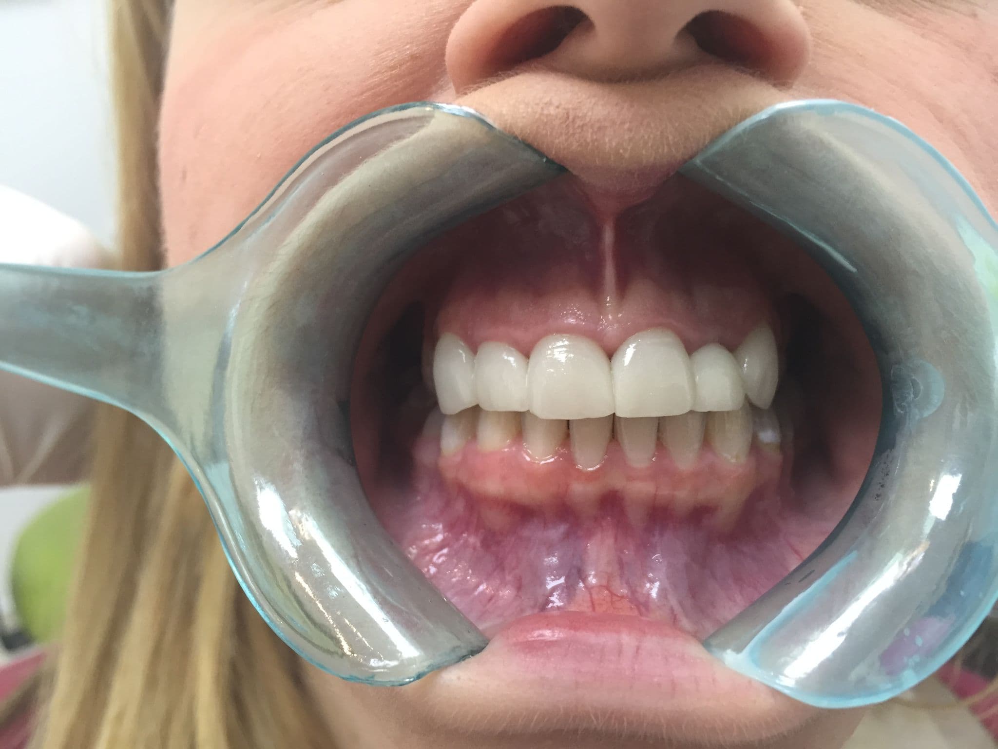 After Porcelain Veneers