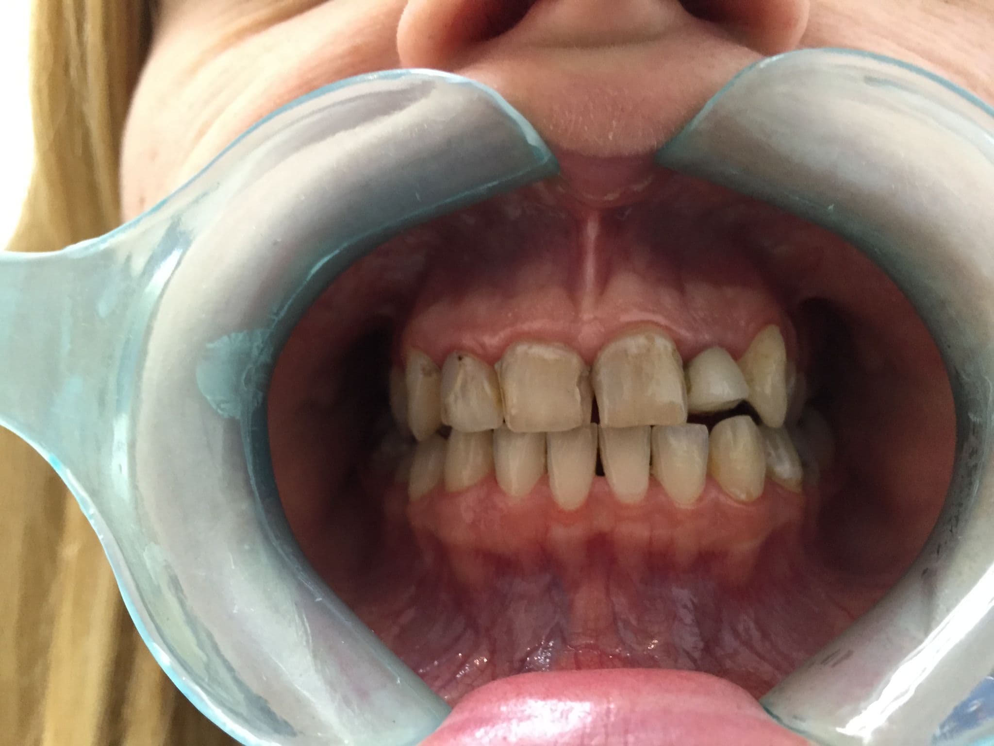 Before Porcelain Veneers