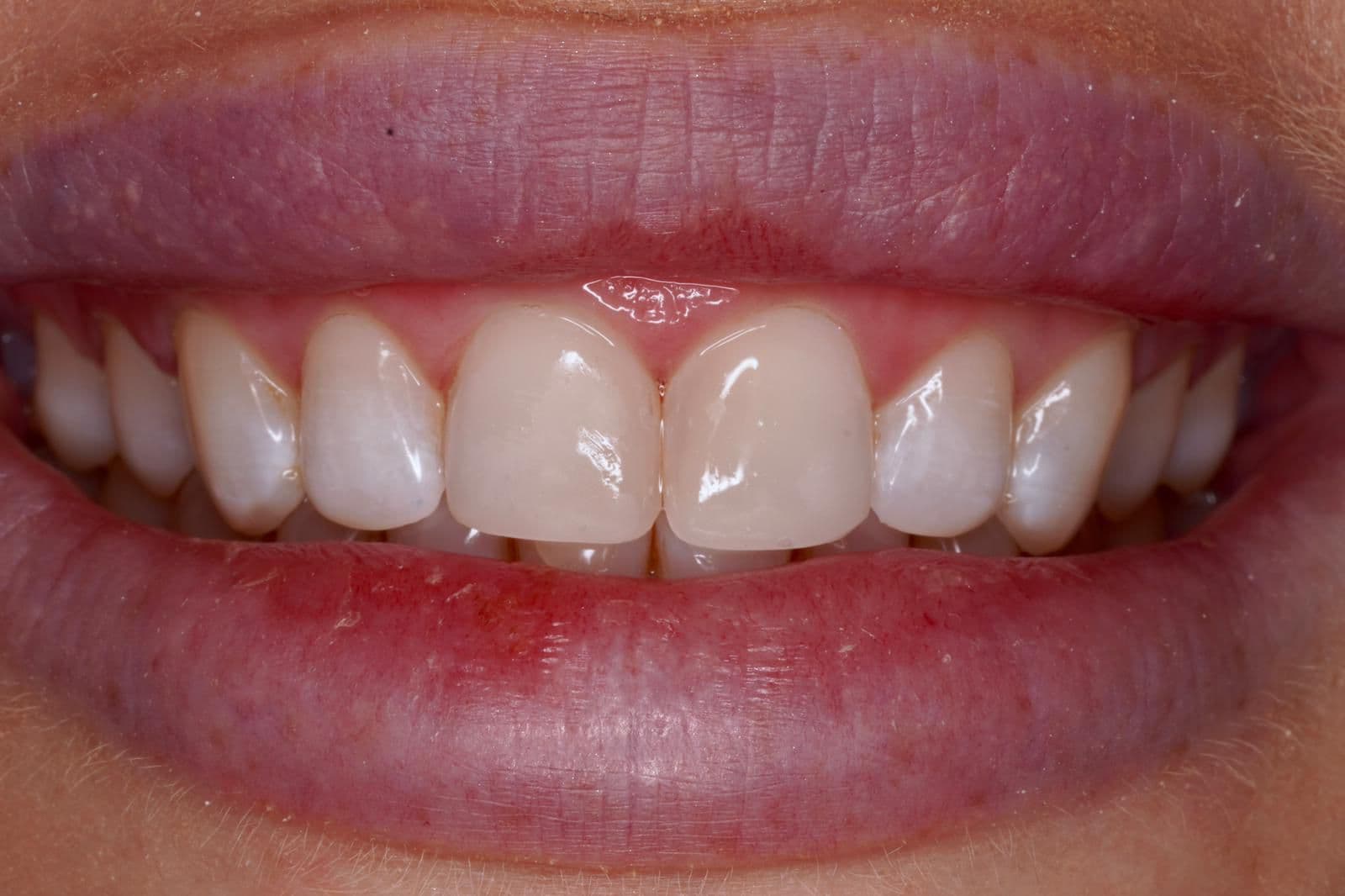 After treatment