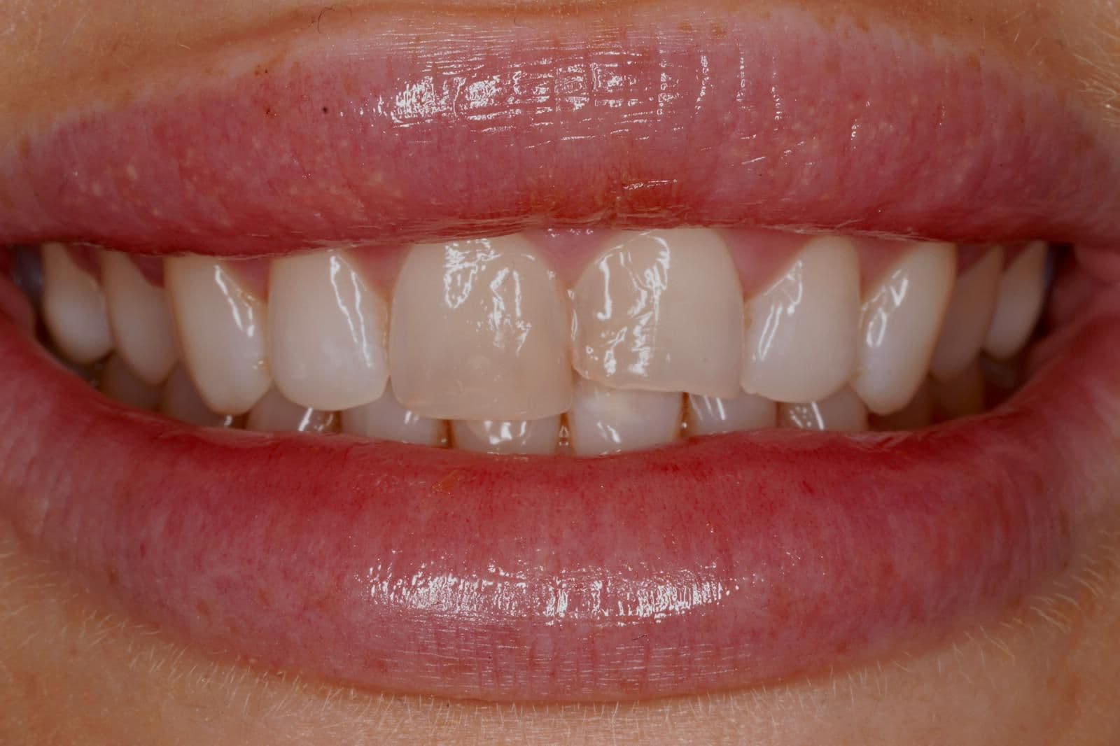 Before treatment