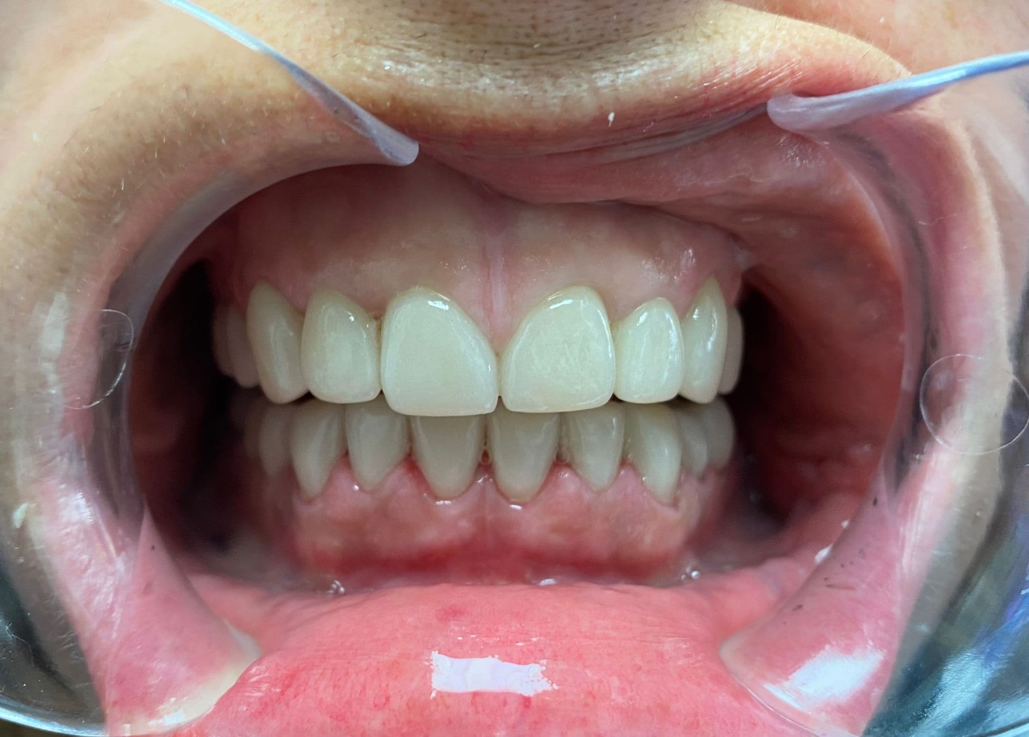 After Porcelain Veneers & Crowns
