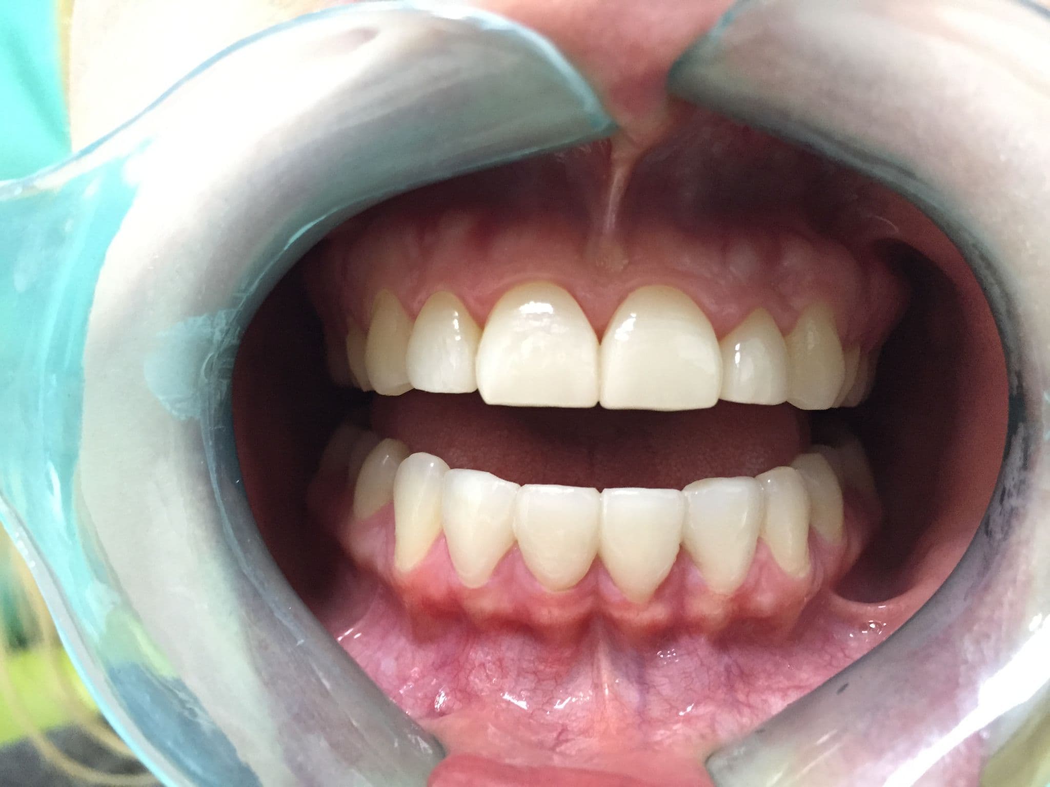 After Porcelain Veneers