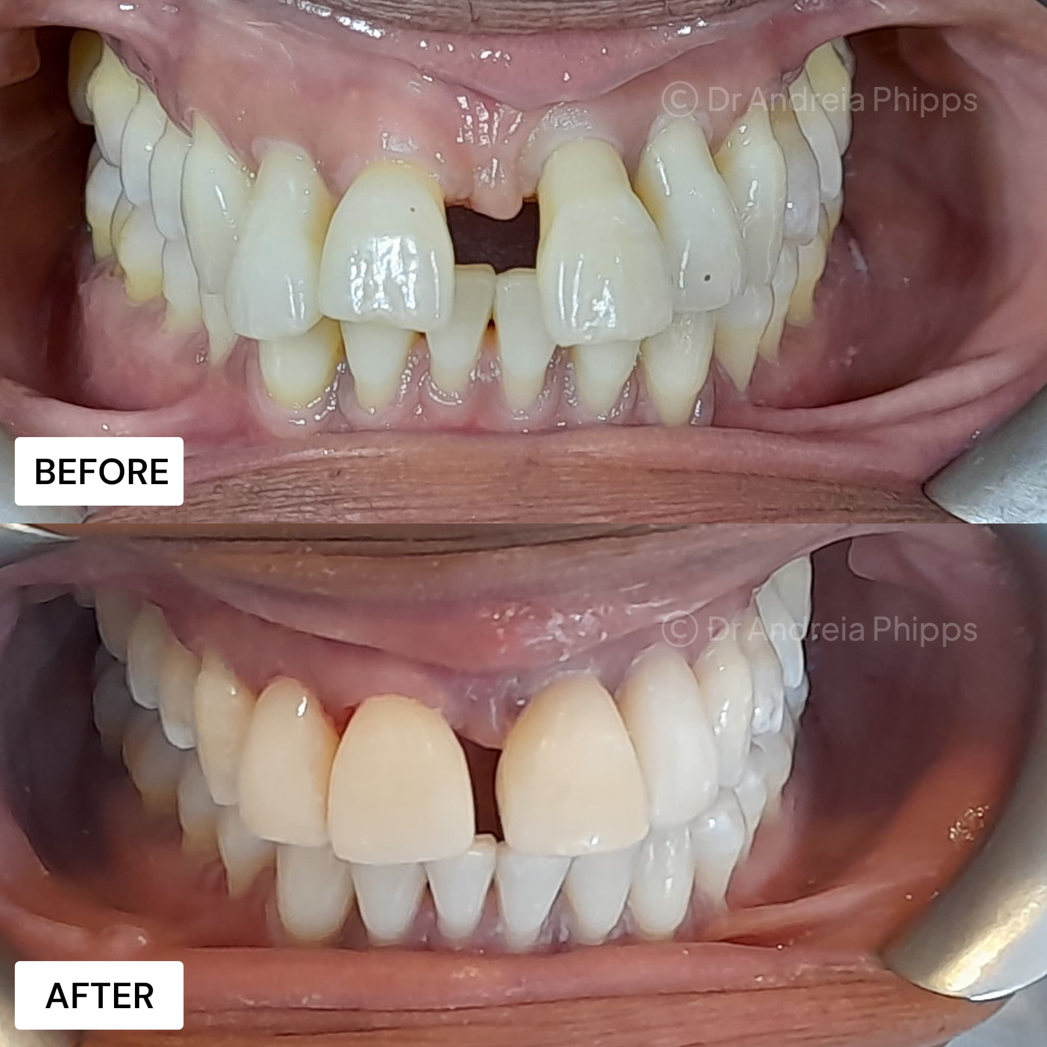 Smile transformation 1