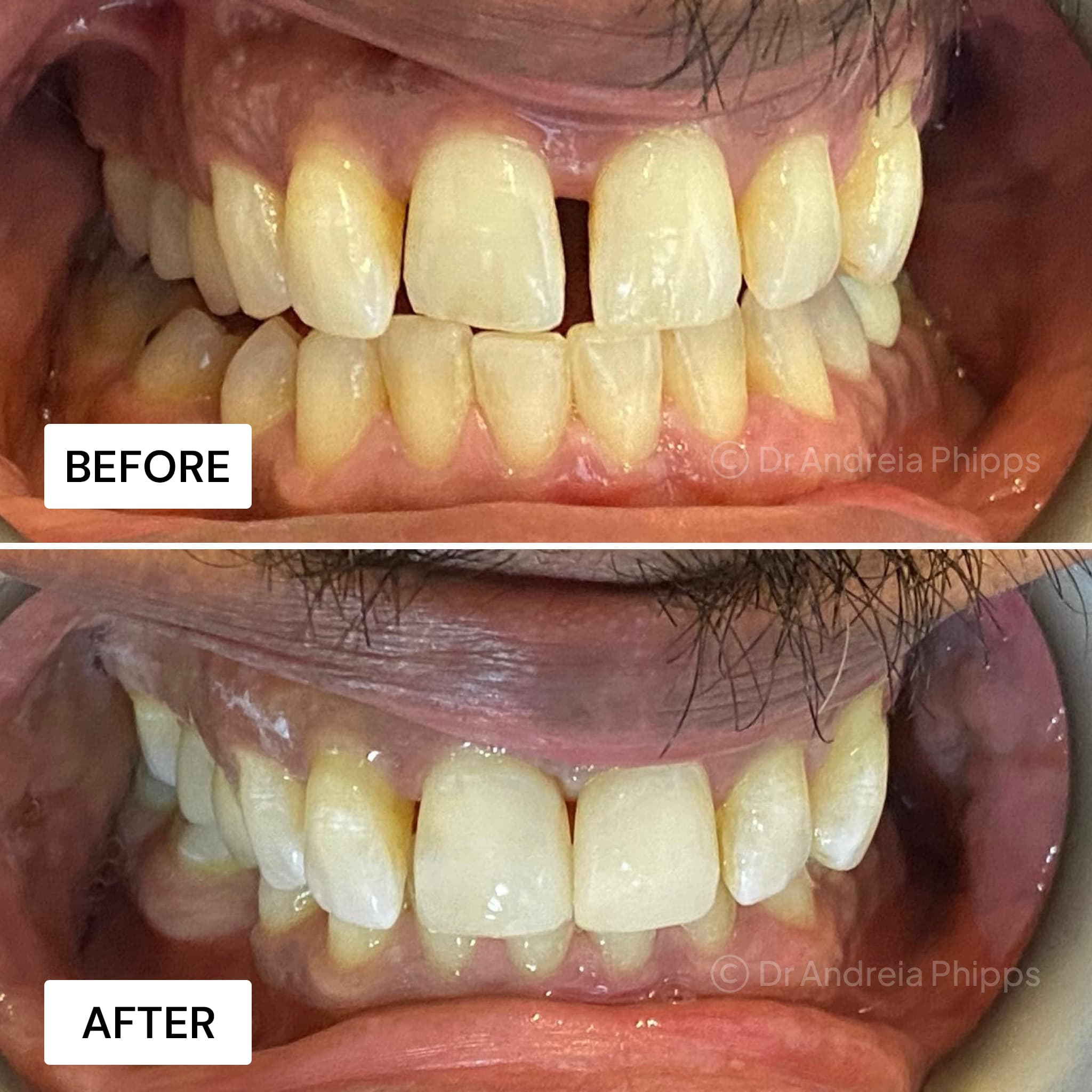 Composite Bonding - Before and After