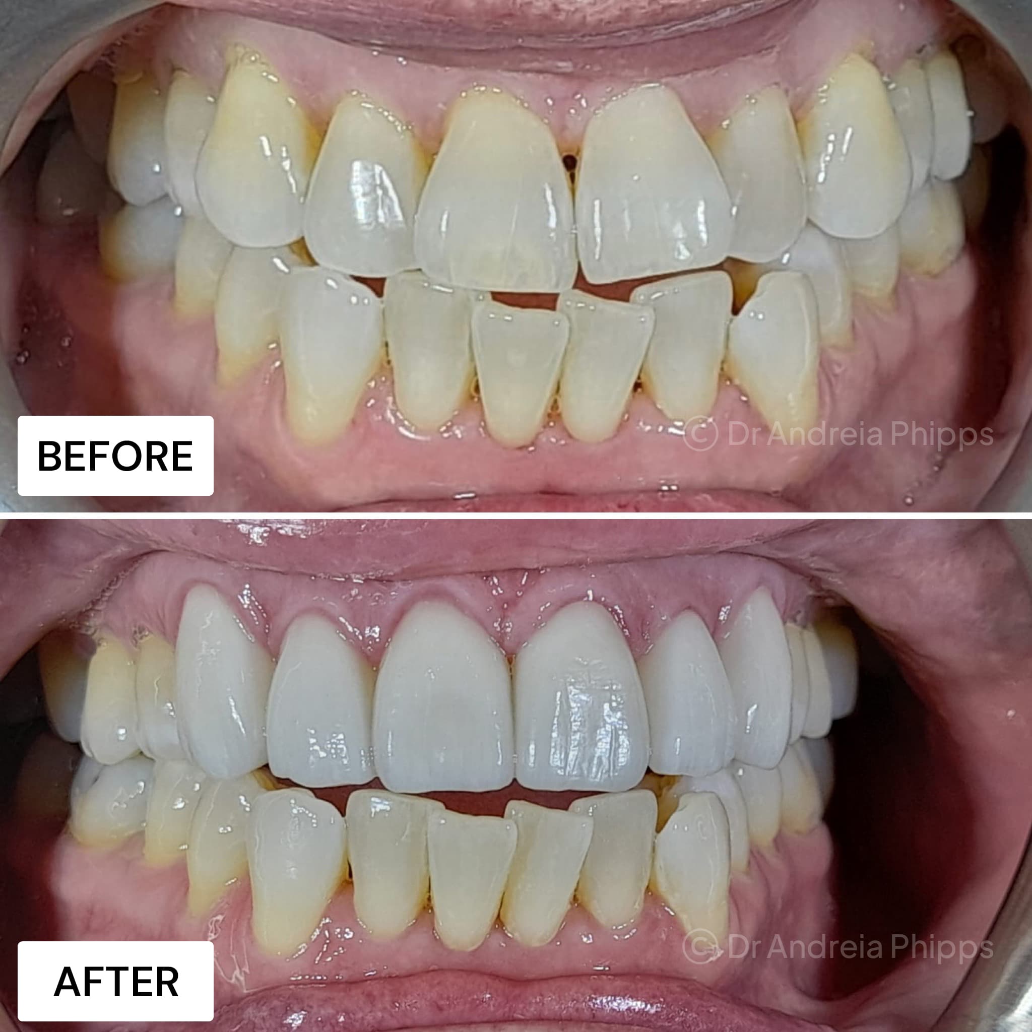 Smile transformation 17