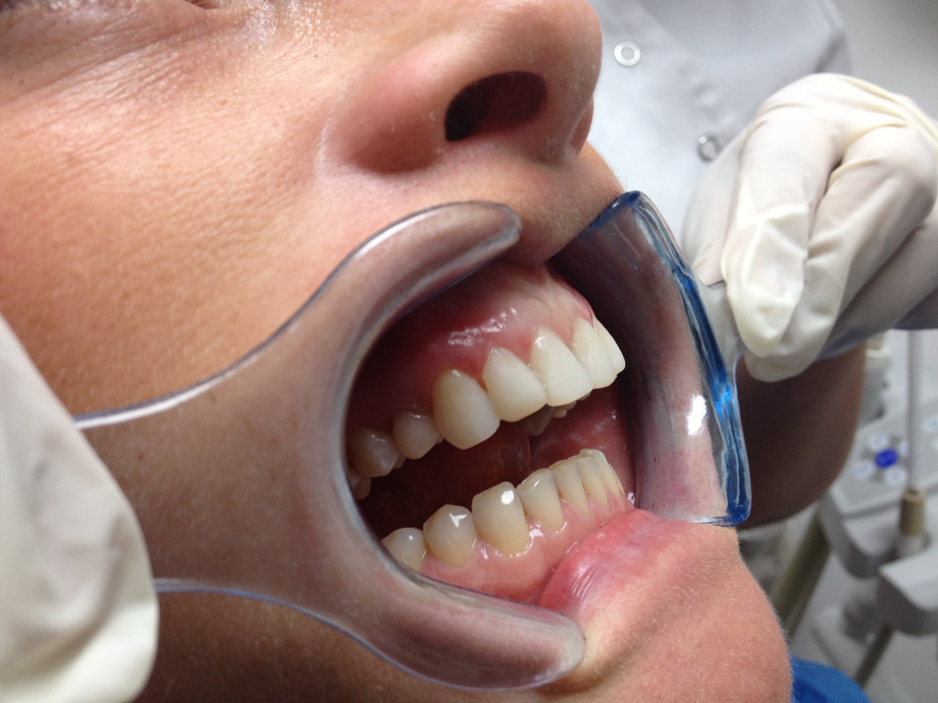 After Composite Bonding