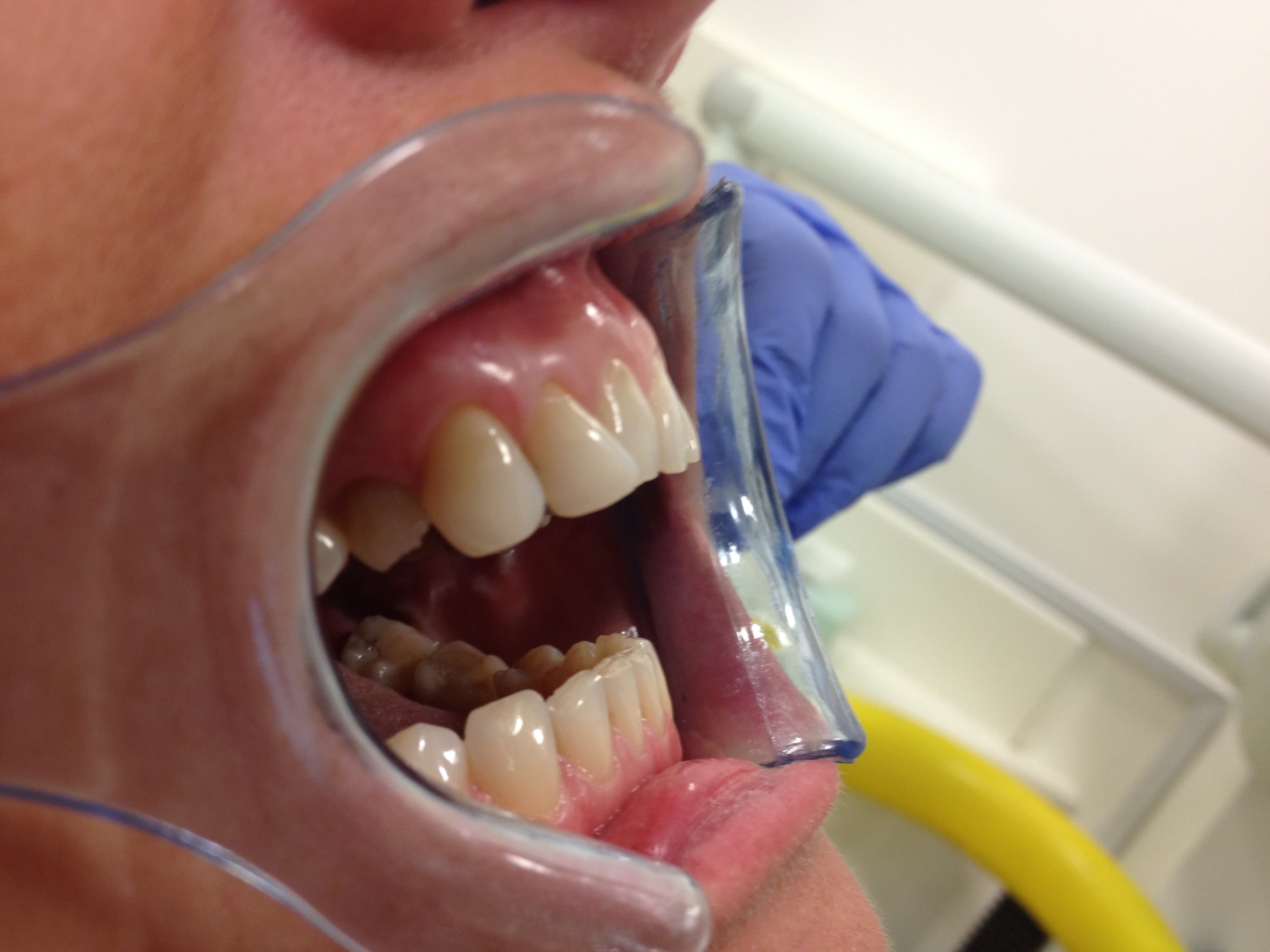Before Composite Bonding