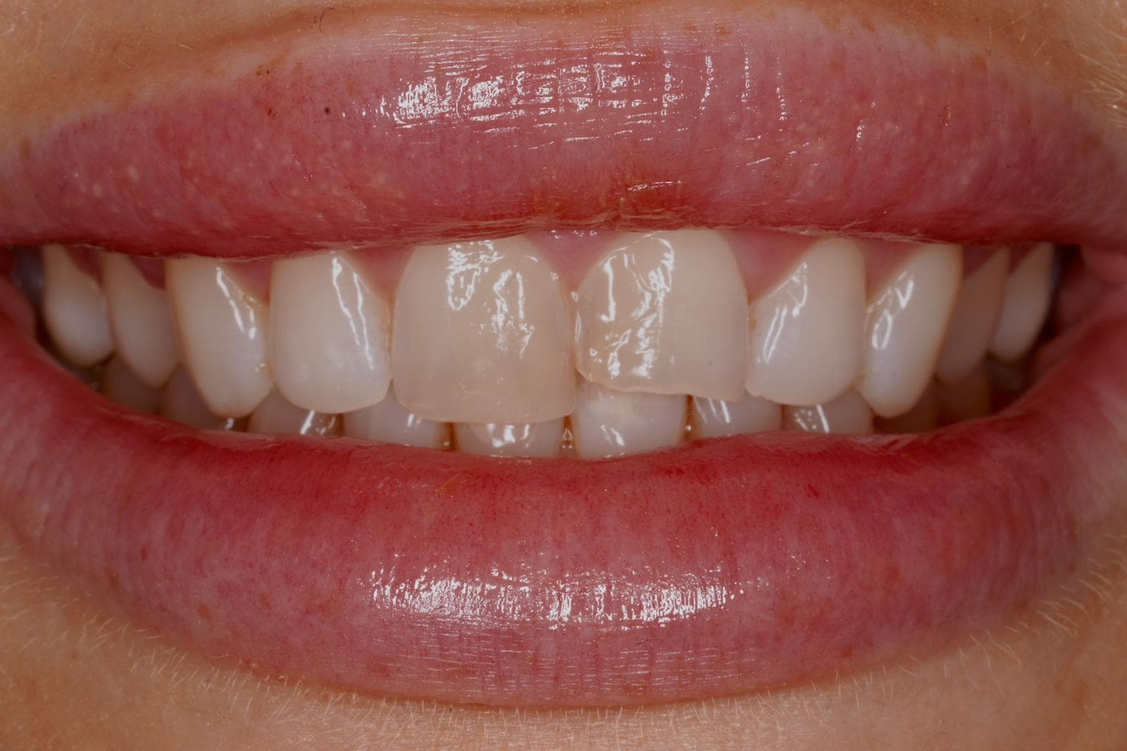 Before treatment