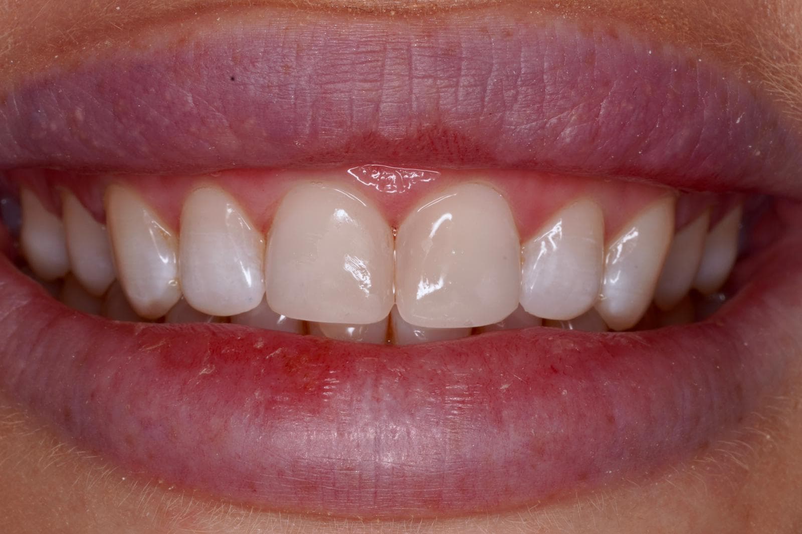 After treatment