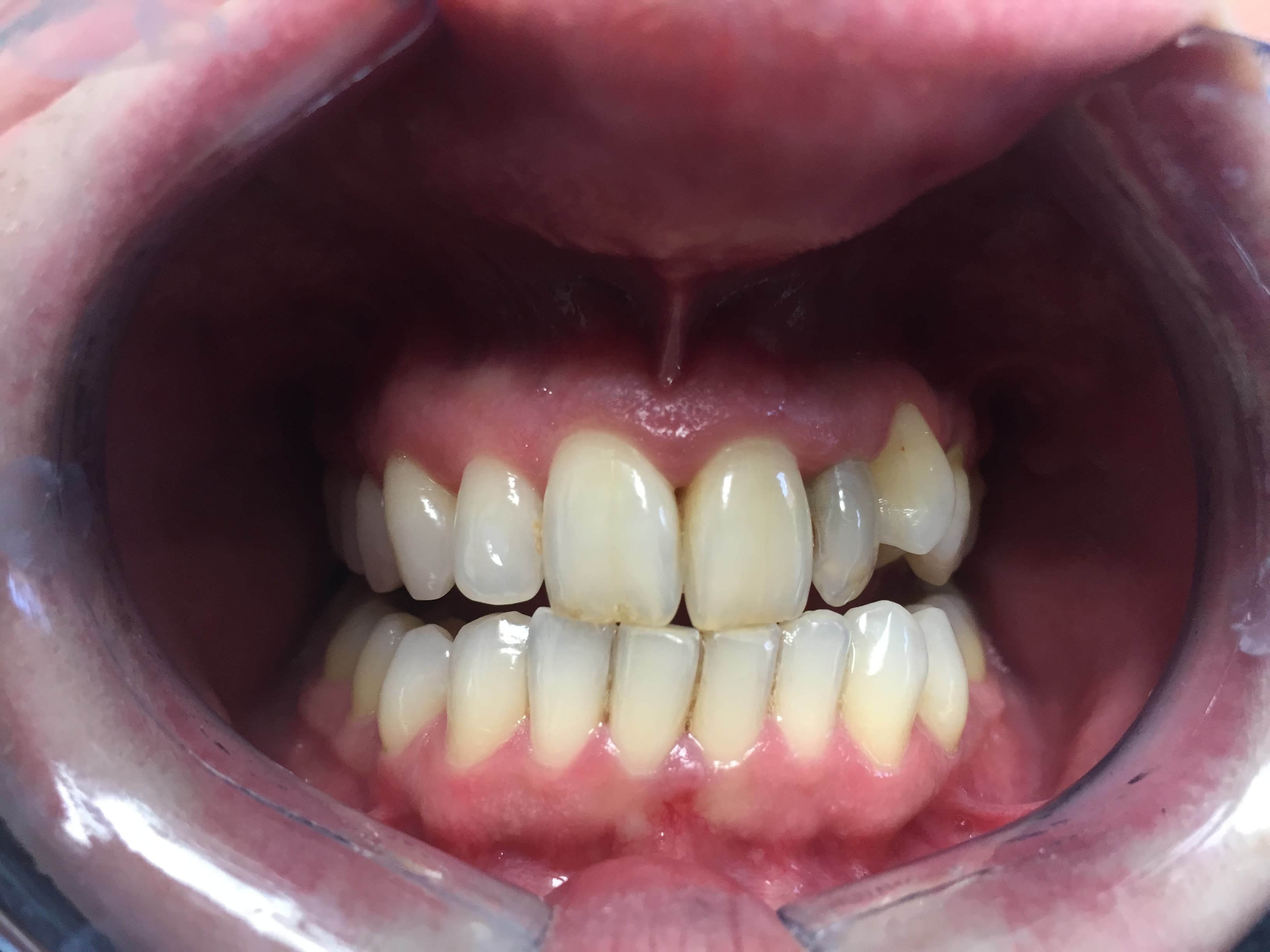Before Teeth Whitening
