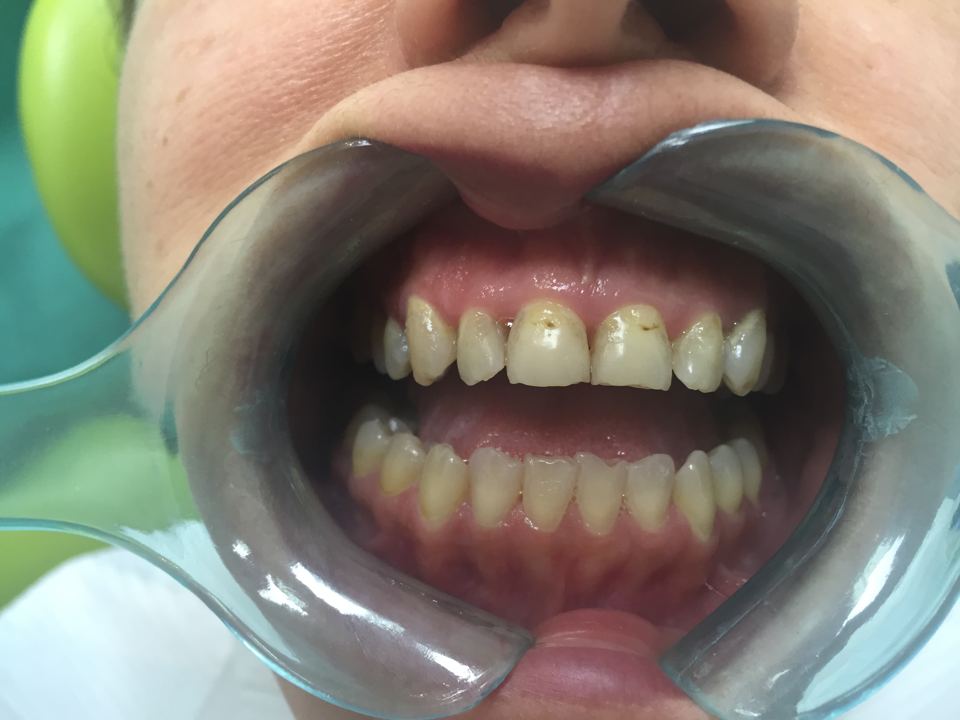 Before Composite Bonding